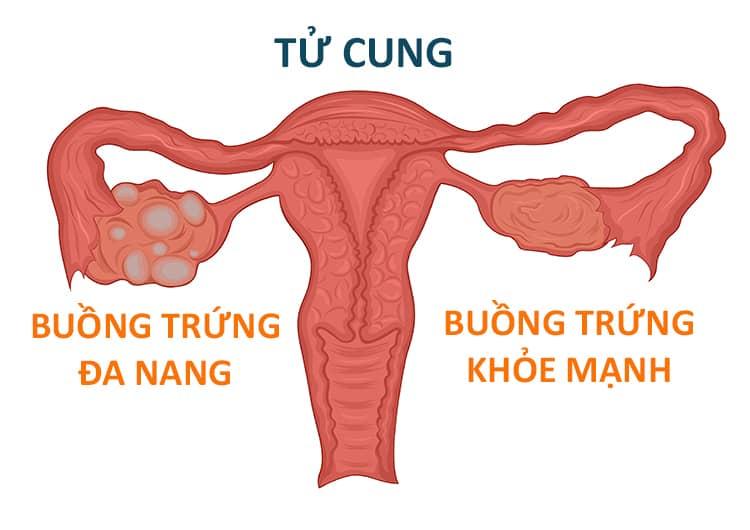 専門家が解説：多嚢胞性卵巣症候群（PCOS）のリスクと治療