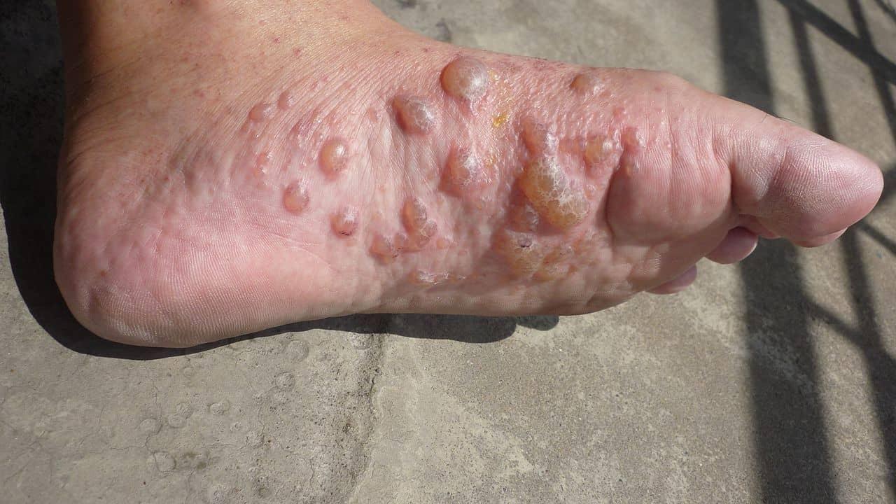 【医師監修】汗疱（異汗性湿疹）の完全ガイド：原因から最新治療まで