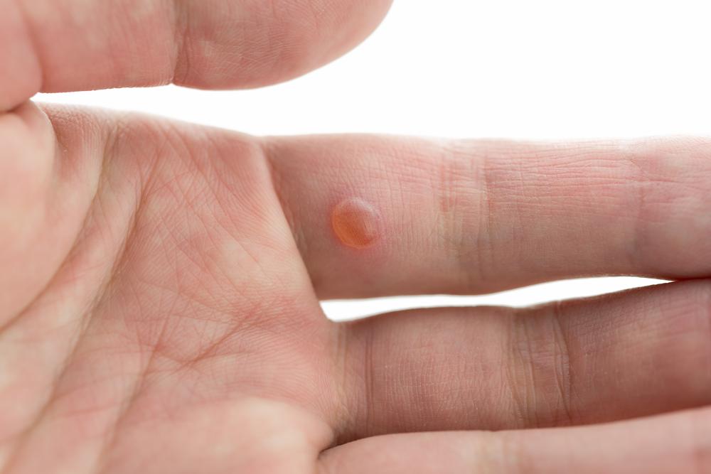 【皮膚科専門医が解説】手の水ぶくれ・かゆみの原因は？汗疱・手湿疹・感染症の見分け方と正しい治し方