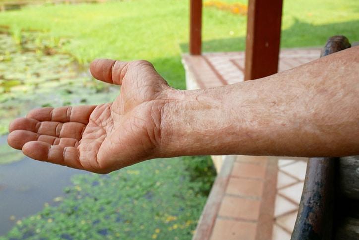 火傷による様々な瘢痕の種類 効果的な治療法とケアの最前線