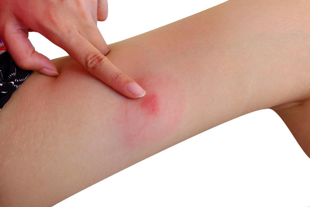 環状肉芽腫とは？原因、症状、治療法、糖尿病との関連性を専門医が徹底解説