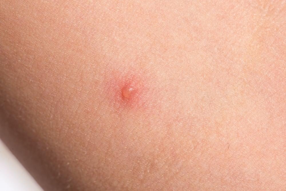 皮膚科医が教える！水疱の効果的な治療法