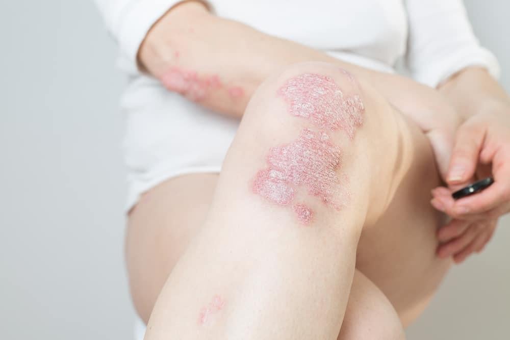乾癬とは？原因、症状、最新治療法、生活上の注意点を専門家が徹底解説