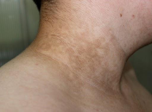 【医師監修】首や脇の黒ずみは危険信号？肥満に伴う黒色表皮症 の原因と科学的治療法の完全ガイド