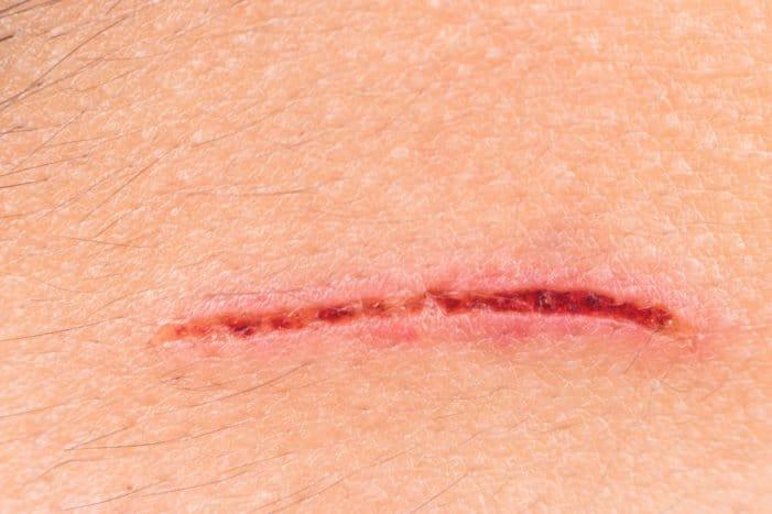 【医師監修】術後の傷跡を残さないために｜原因から予防法、市販薬、最新治療まで形成外科専門医が徹底解説