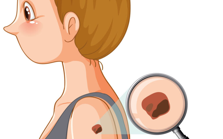 ケロイドと肥厚性瘢痕の自宅ケア完全ガイド:科学的根拠に基づく効果的な改善法 13 ケロイドと肥厚性瘢痕の自宅ケア完全ガイド:科学的根拠に基づく効果的な改善法