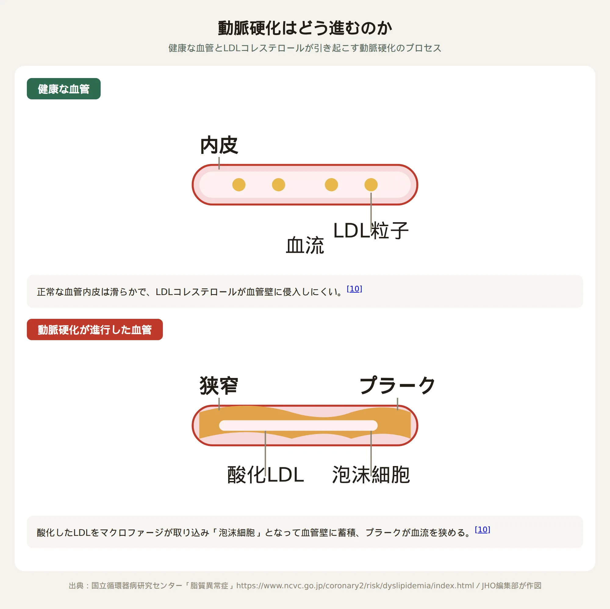 動脈硬化の進行を示す血管断面のイラスト：健康な血管とプラークが蓄積した血管