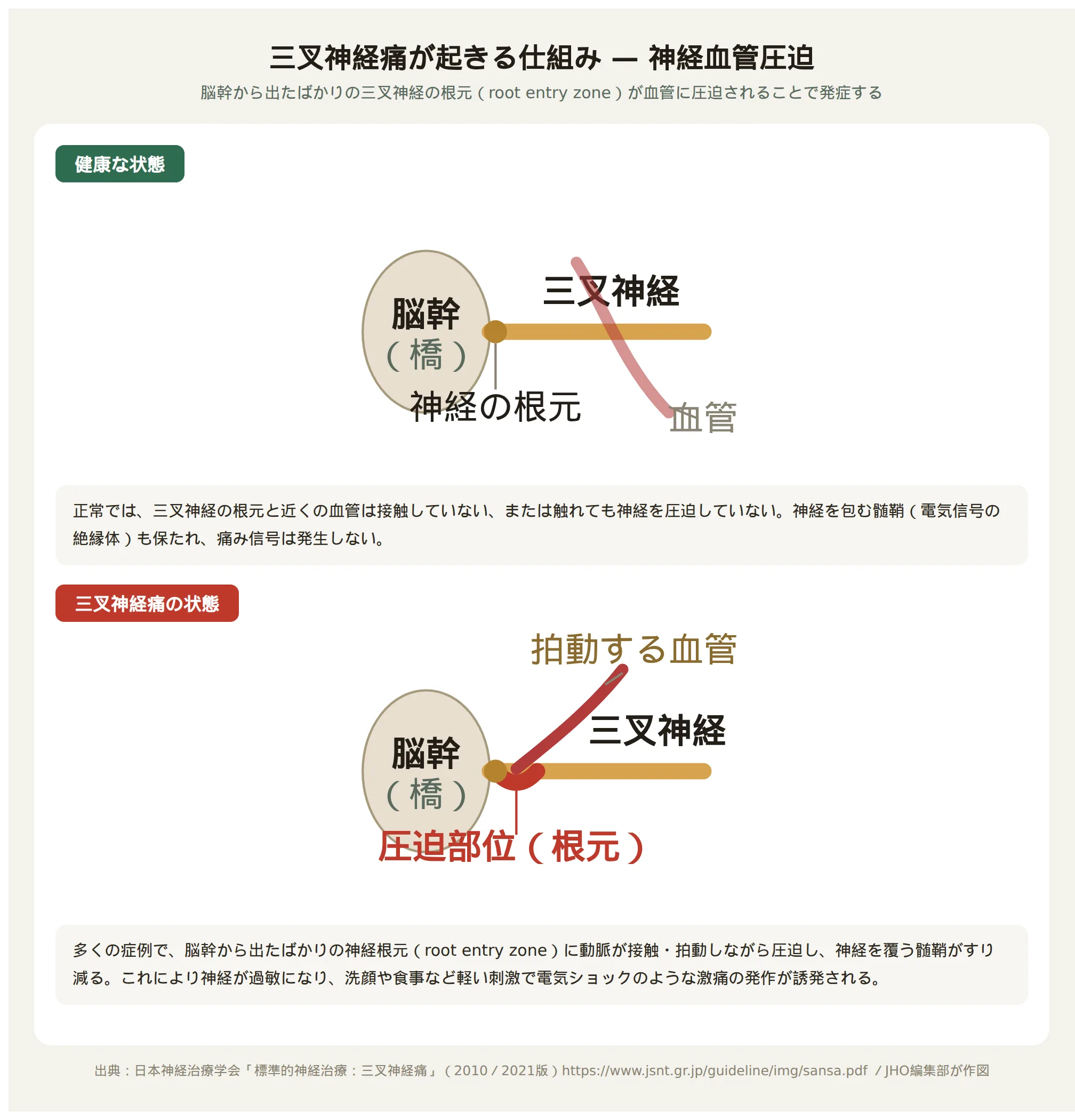 三叉神経痛のメカニズム図：健康な神経と血管圧迫を受けた神経の違い