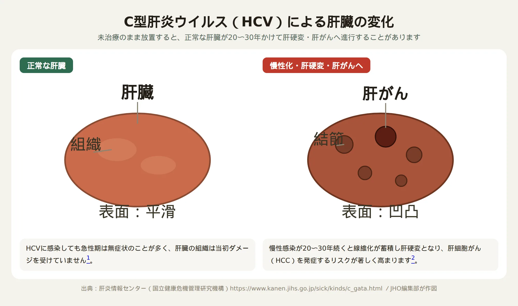 C型肝炎ウイルスによる肝臓の変化：正常な肝臓と肝硬変・肝がんへ進行した肝臓の図