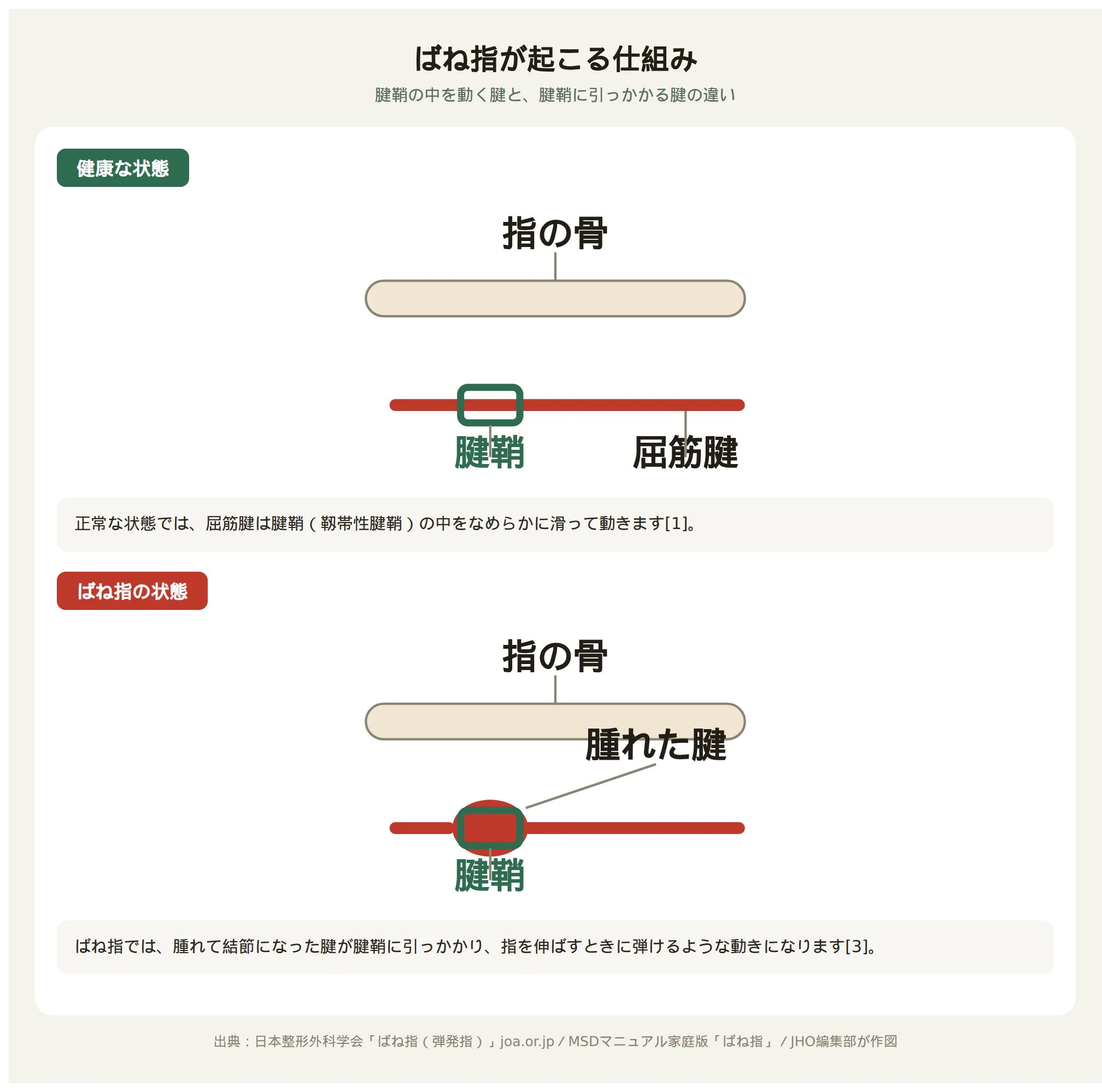 正常な腱の動きと、腱鞘に引っかかって伸びなくなった腱を比較した図
