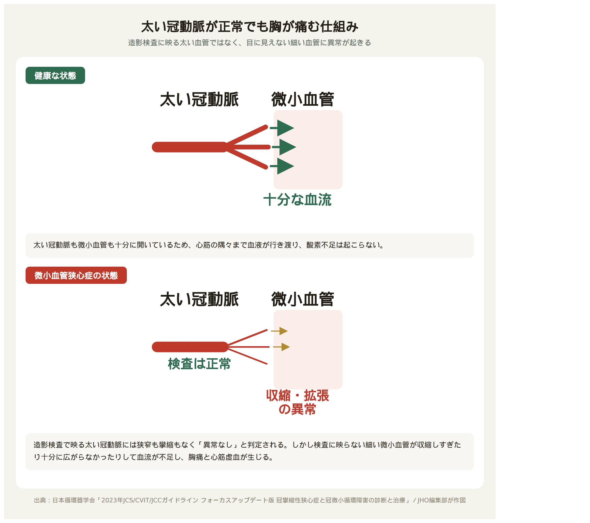 太い冠動脈が正常でも胸が痛む仕組みを示す図解。健康な状態では微小血管まで十分に血流が届くが、微小血管狭心症の状態では太い冠動脈は正常でも微小血管が収縮・拡張の異常を起こし血流が不足する