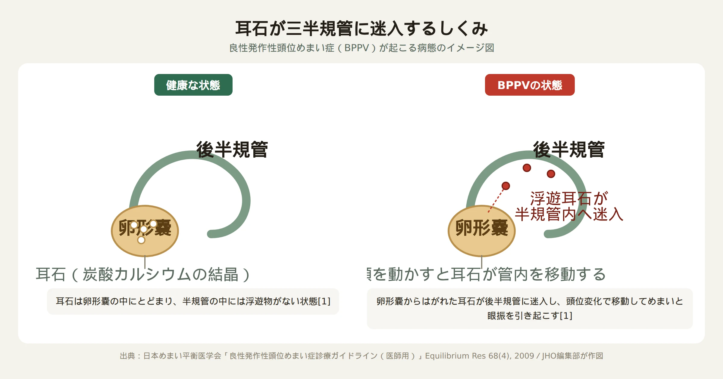 良性発作性頭位めまい症で耳石が三半規管に迷入する仕組みを示した図