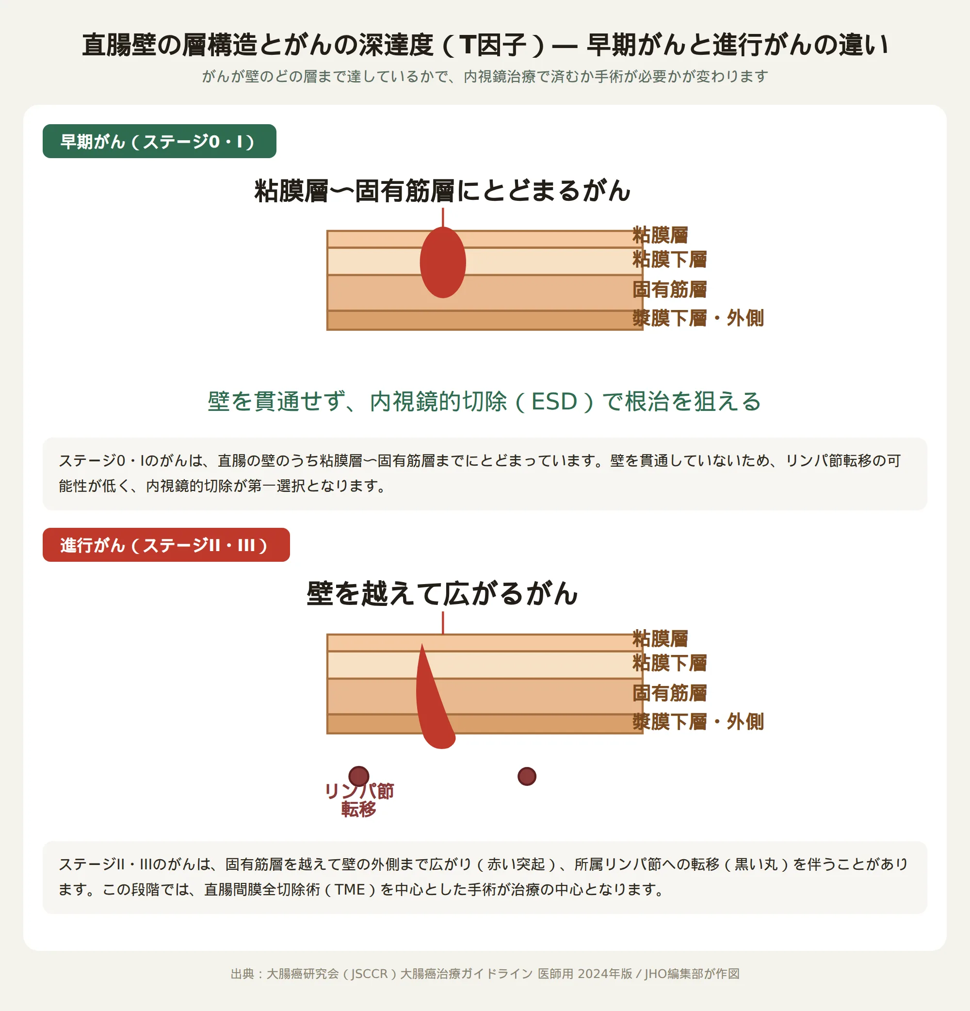 直腸壁の層構造とがんの深達度（T因子）の図。早期がんは粘膜層〜固有筋層にとどまり、進行がんは壁を越えてリンパ節転移を伴う様子