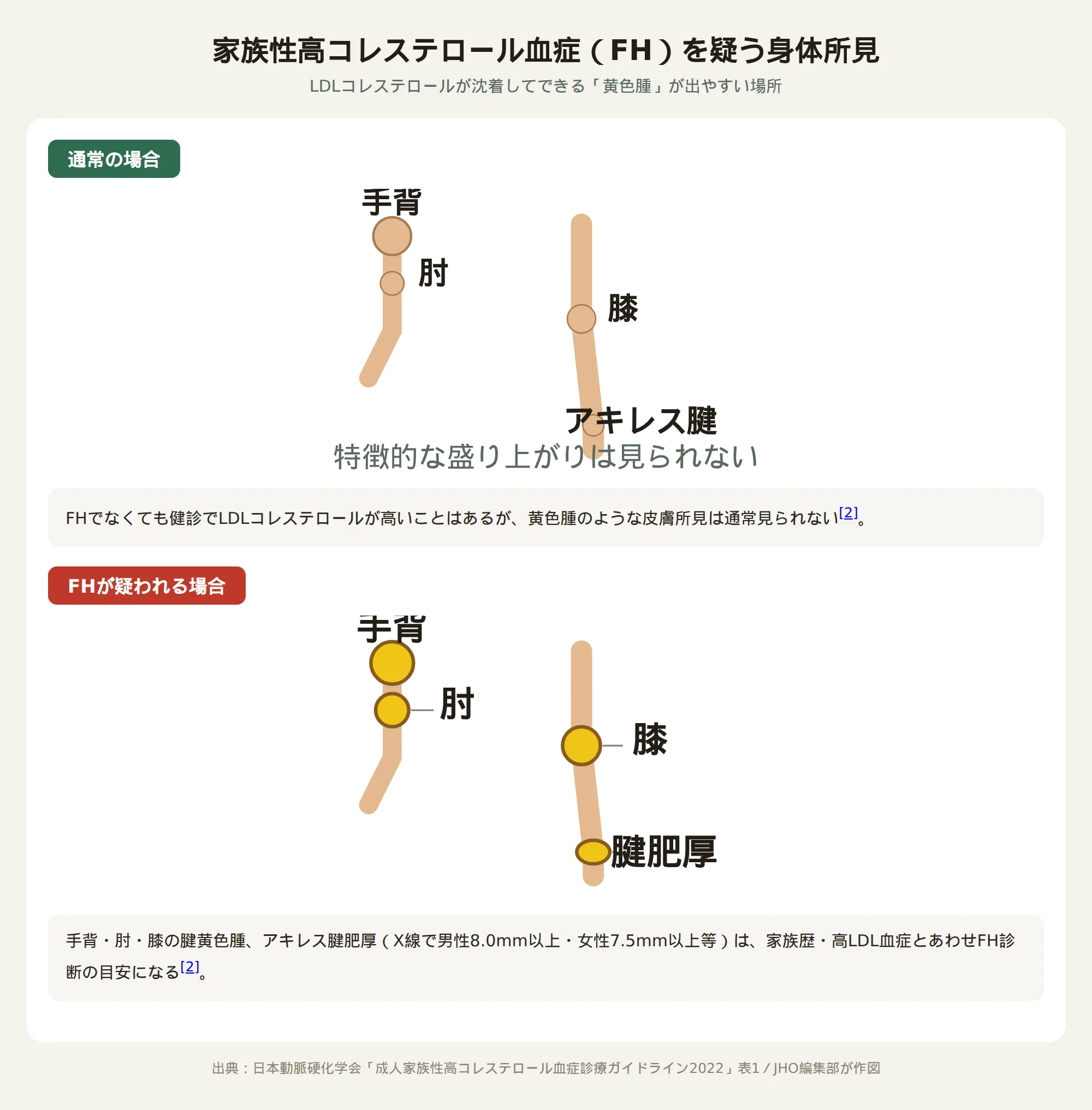 家族性高コレステロール血症を疑う身体所見（黄色腫の出やすい場所）