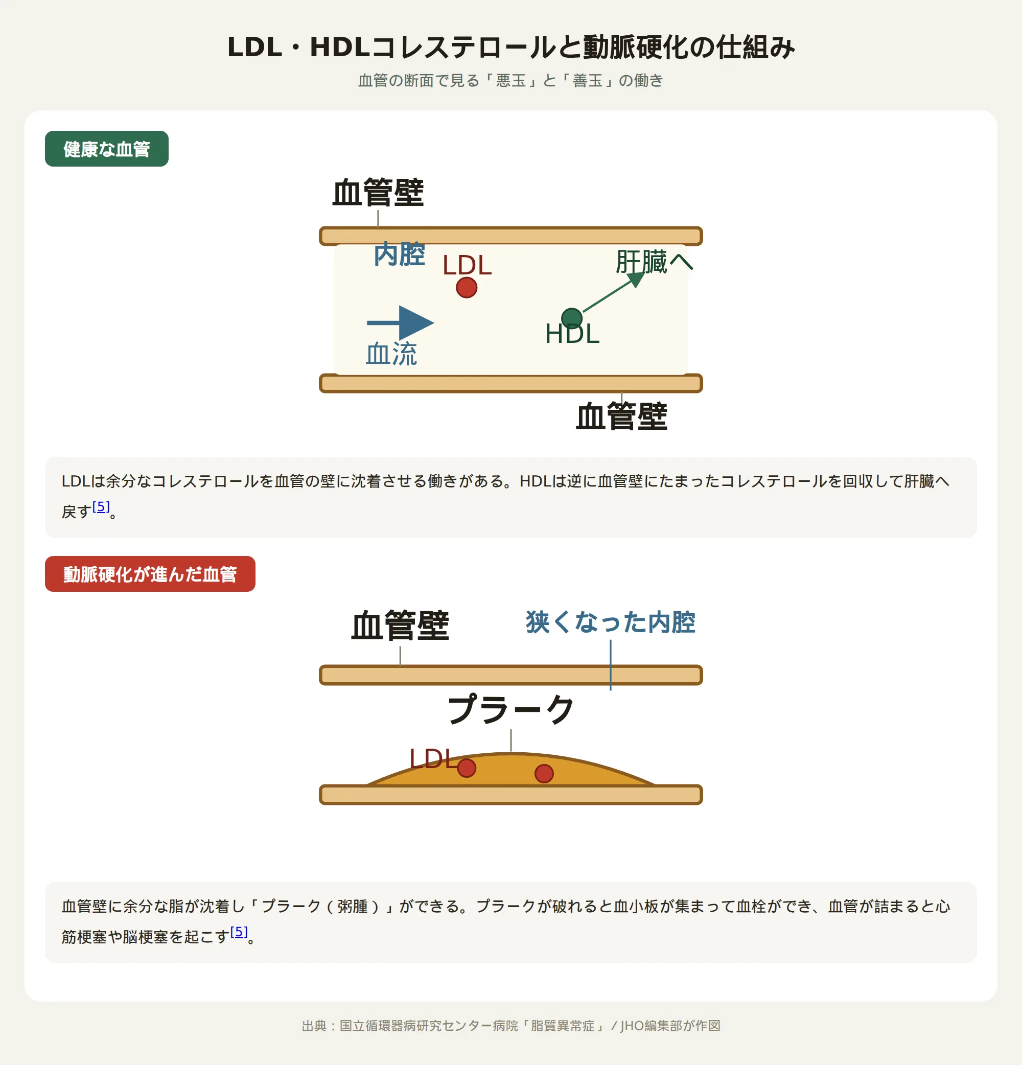 LDL・HDLコレステロールと動脈硬化の仕組みを示す血管断面図