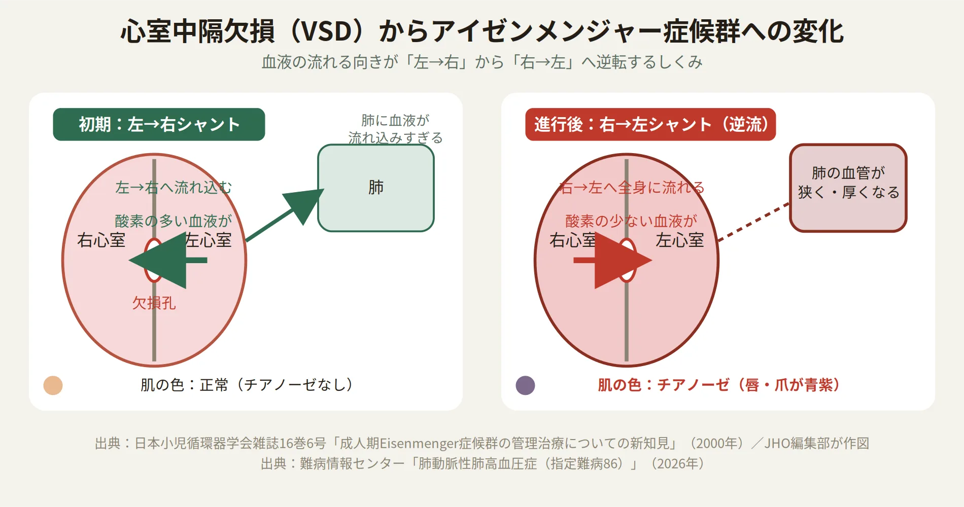 アイゼンメンジャー症候群の病態を示す図