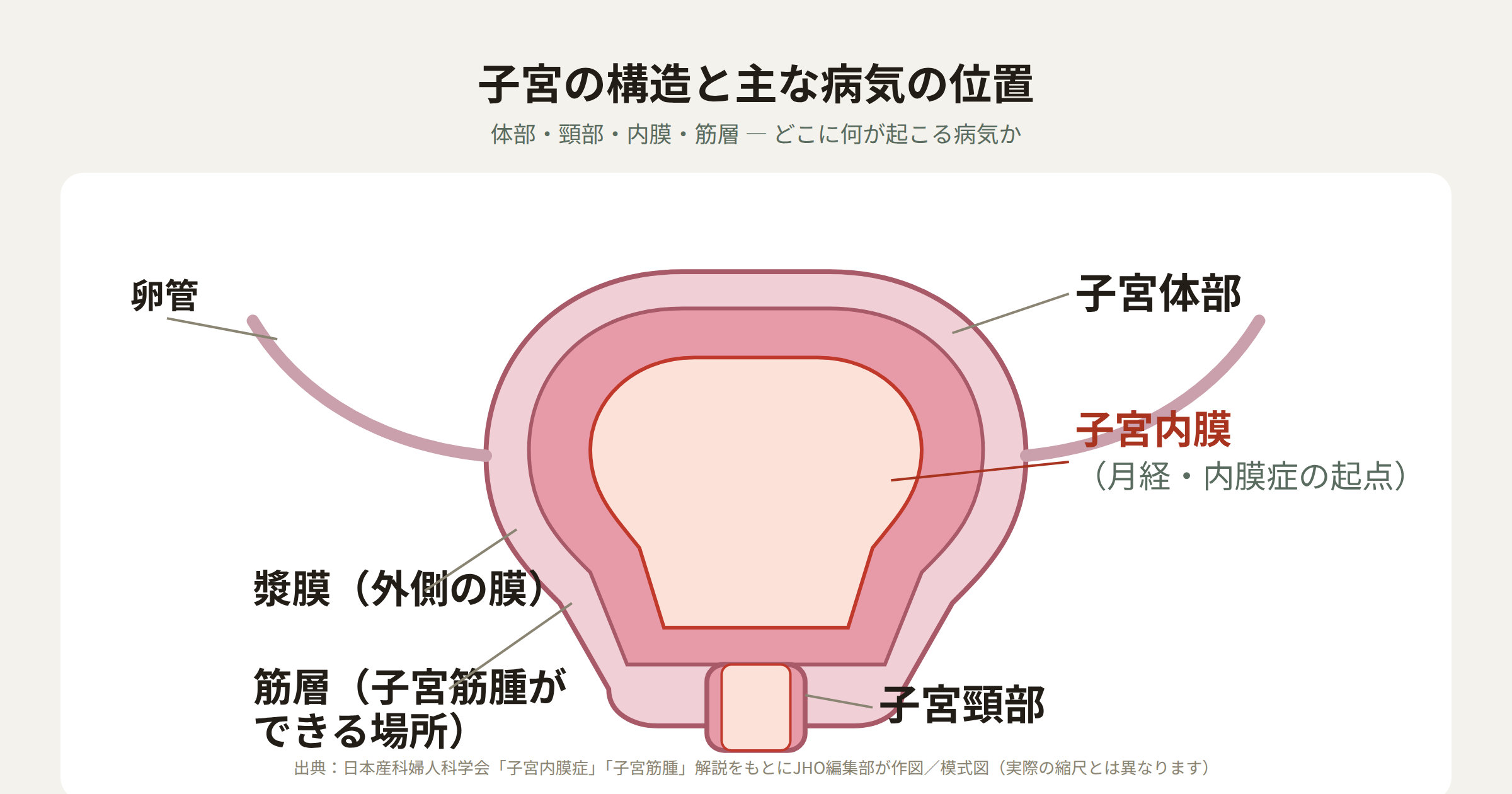 子宮を正面から見た断面図。体部・頸部・内膜・筋層の位置関係を示す模式図