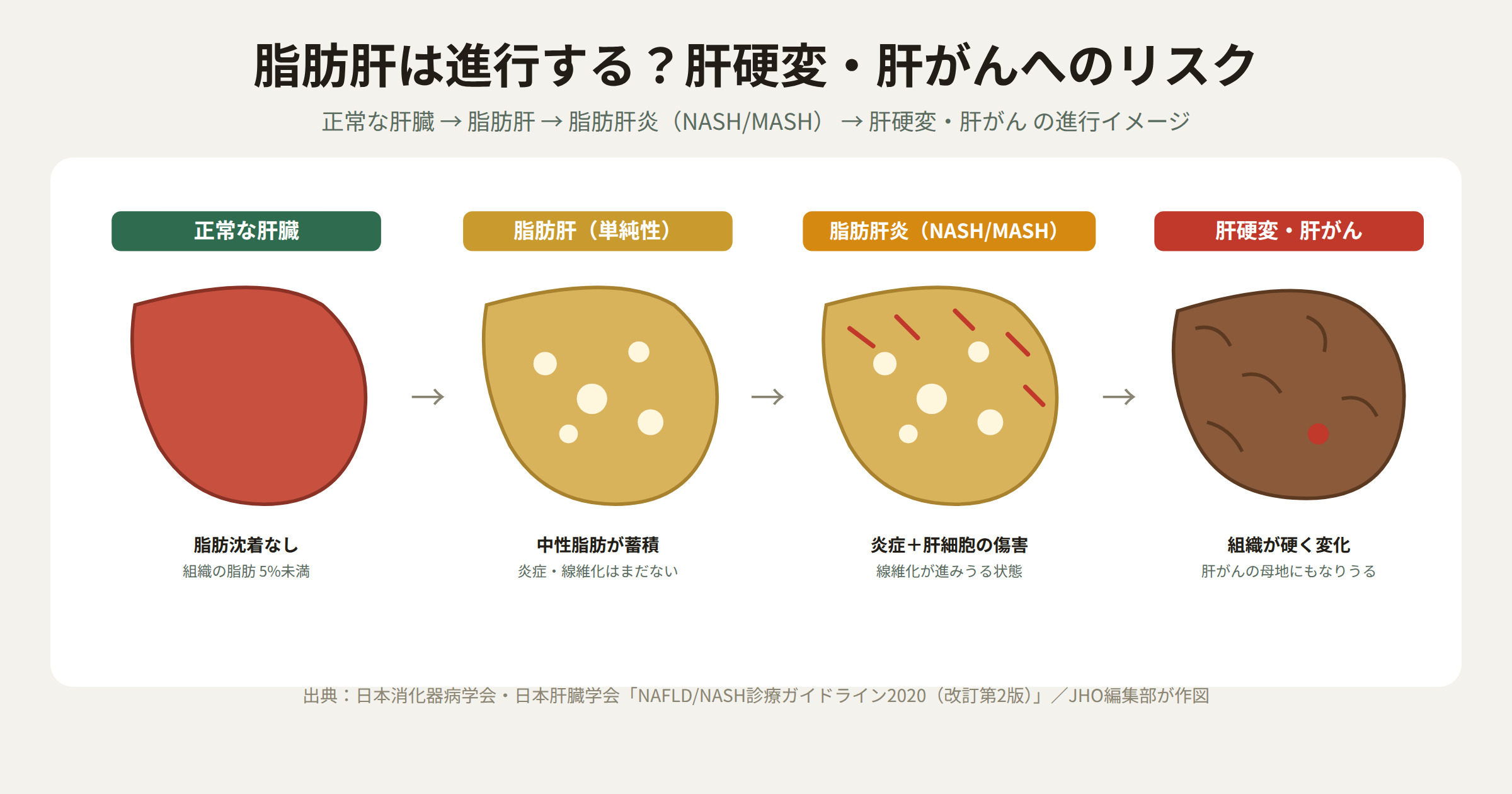 正常な肝臓から脂肪肝、脂肪肝炎（NASH／MASH）を経て肝硬変・肝がんへ進行する4段階を示す図。脂肪の蓄積、炎症と肝細胞の傷害、組織の硬化という変化を表す