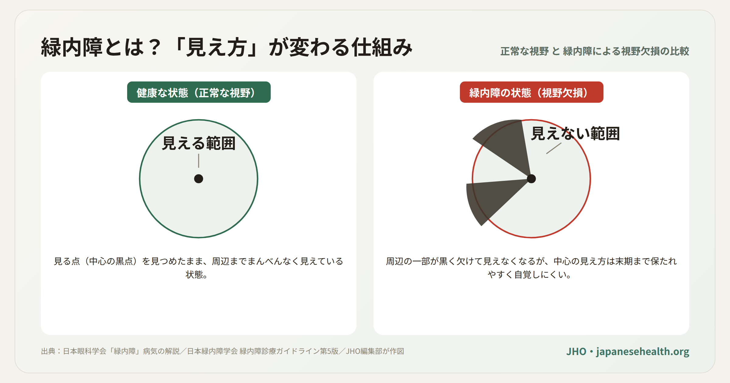 正常な視野と、緑内障で周辺の視野が欠けていく様子を比較した模式図