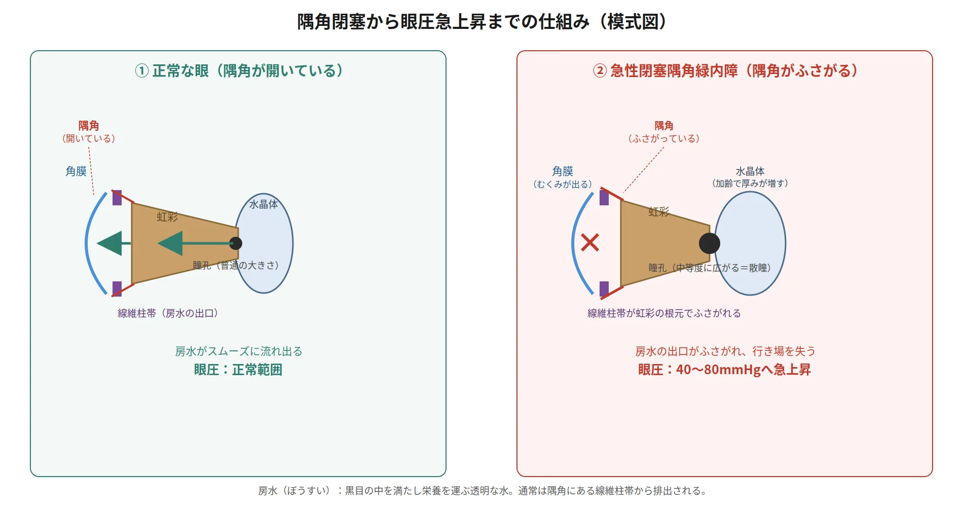 急性閉塞隅角緑内障の発作が起こる目の断面図。虹彩が押し上げられて隅角がふさがり、房水の出口を失っていく様子を示す模式図。