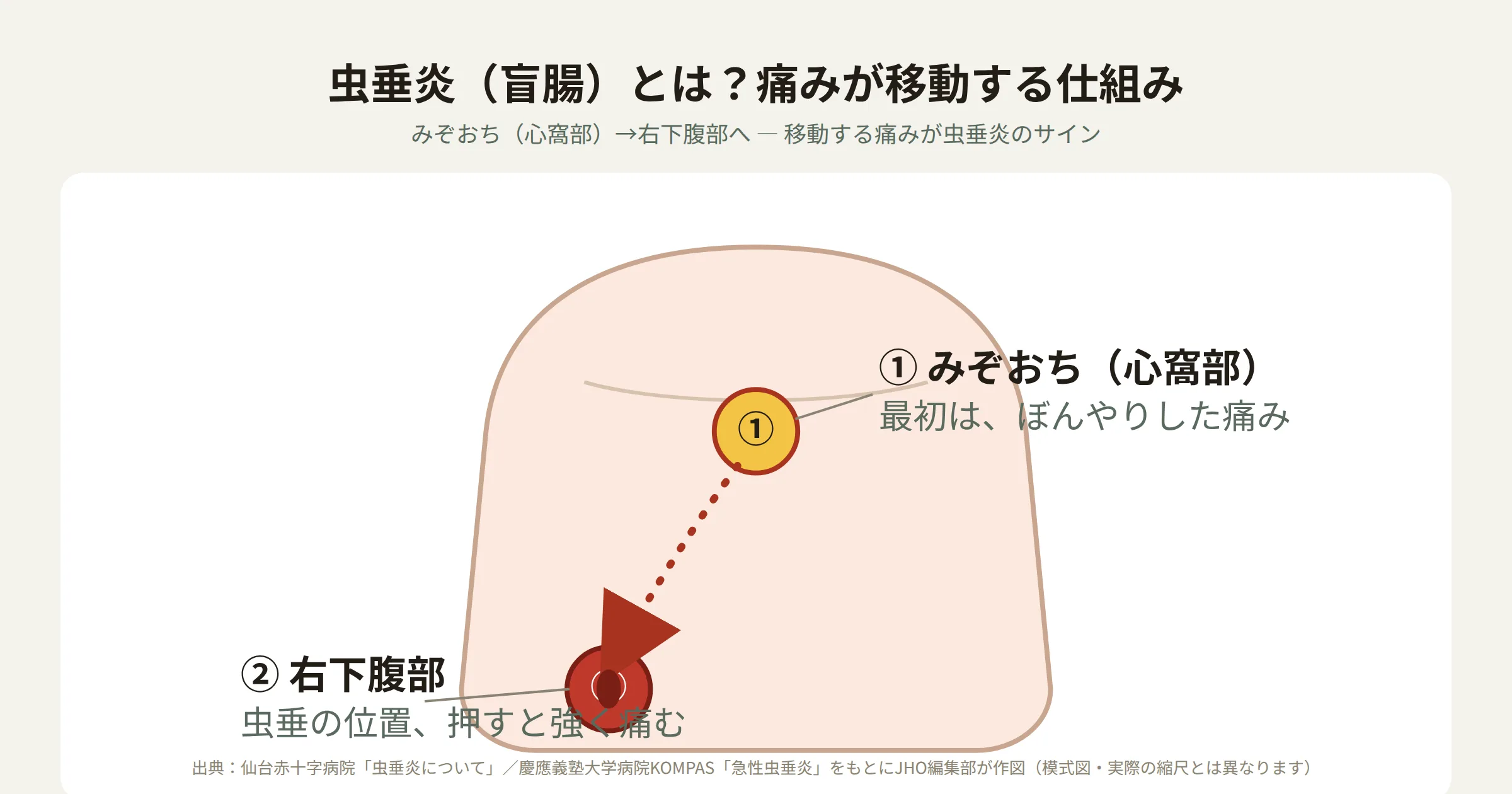 虫垂炎（盲腸）の痛みの移動（心窩部→右下腹部）と手術・保存的治療の比較図