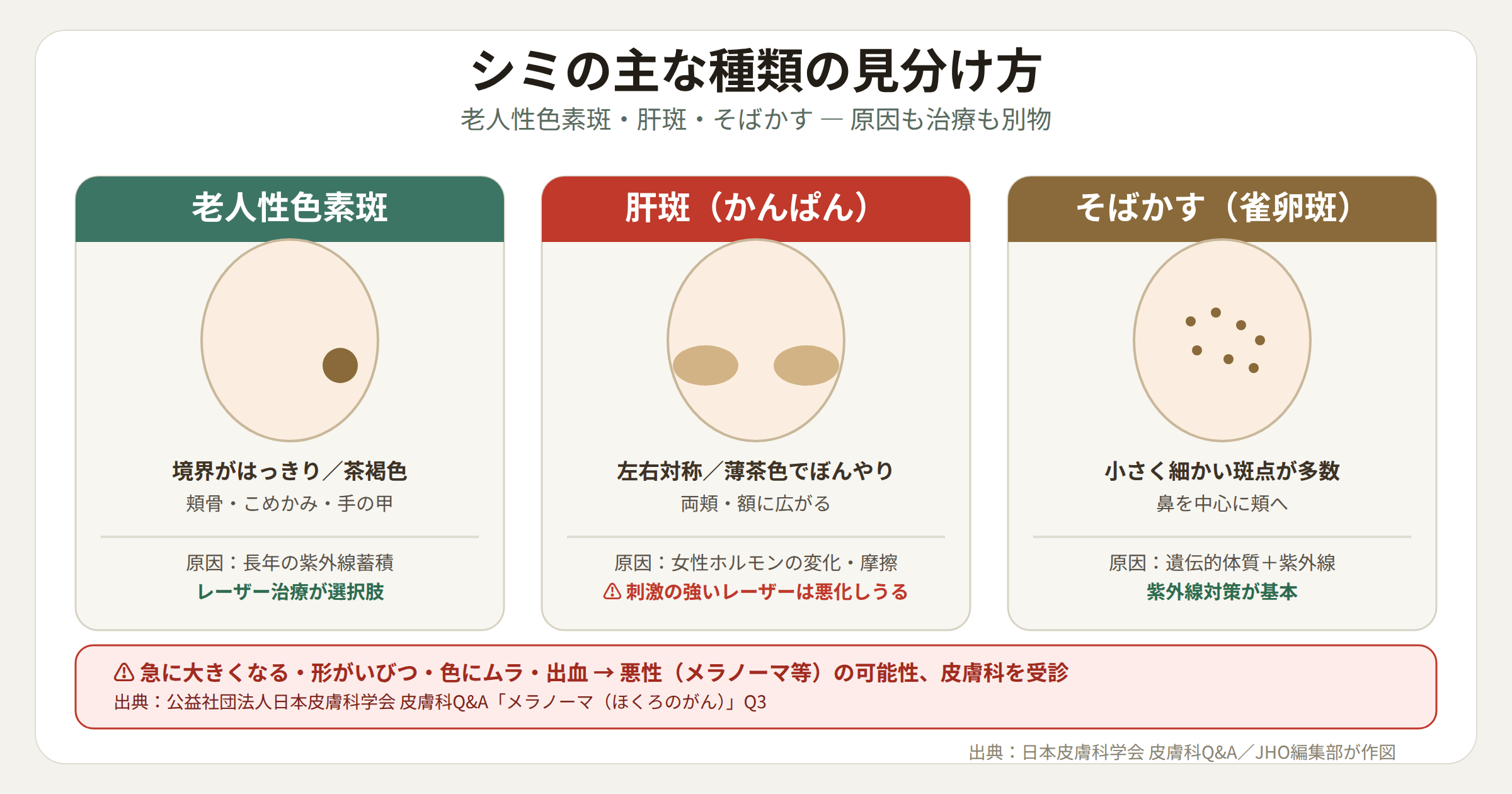 シミの主な種類（老人性色素斑・肝斑・そばかす）の見分け方の比較図