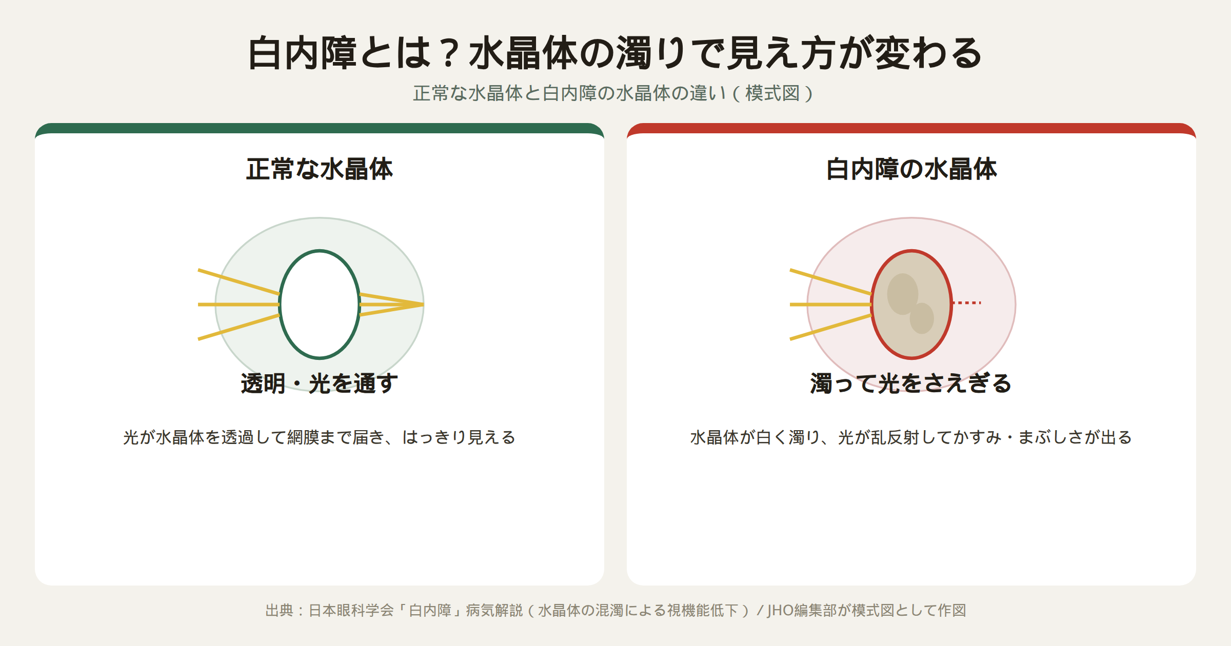正常な透明な水晶体と、白く濁った白内障の水晶体を比較した模式図。健康な水晶体は光をそのまま通すが、白内障の水晶体は濁って光を乱反射させる