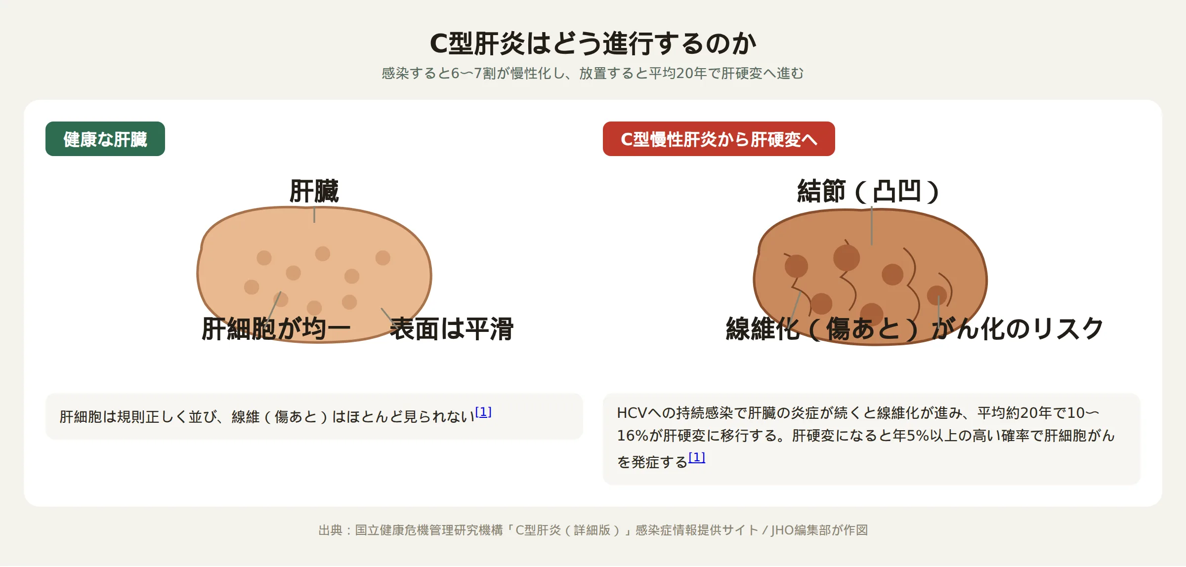 健康な肝臓とC型慢性肝炎から肝硬変への進行を比較した図。健康な肝臓は肝細胞が均一で表面が平滑だが、C型慢性肝炎が進行すると線維化と結節（凸凹）が生じ肝硬変となり、肝細胞がんのリスクが高まる