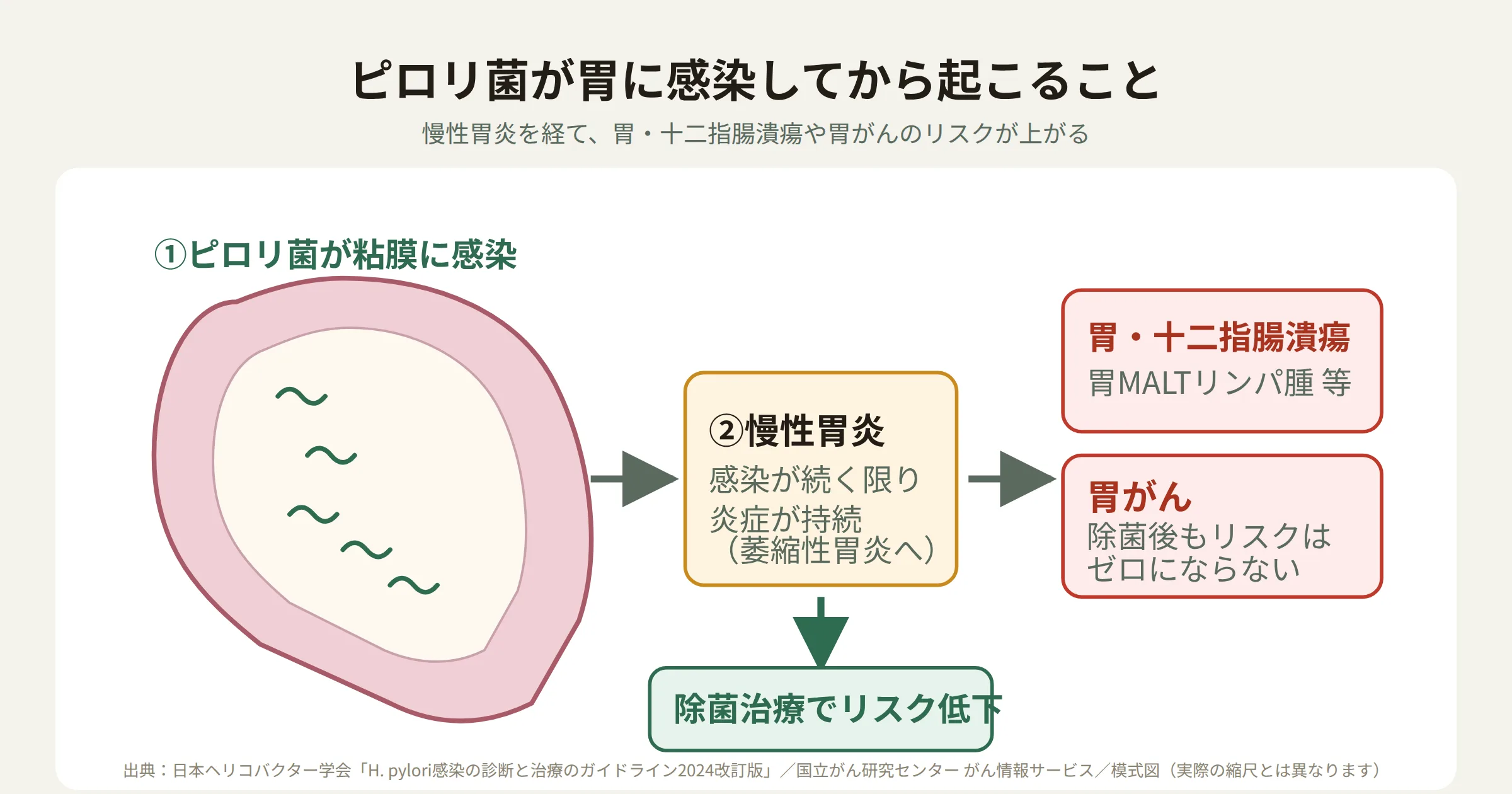 ピロリ菌が胃の粘膜に感染してから慢性胃炎を経て胃・十二指腸潰瘍や胃がんのリスクが上がる流れを示す図