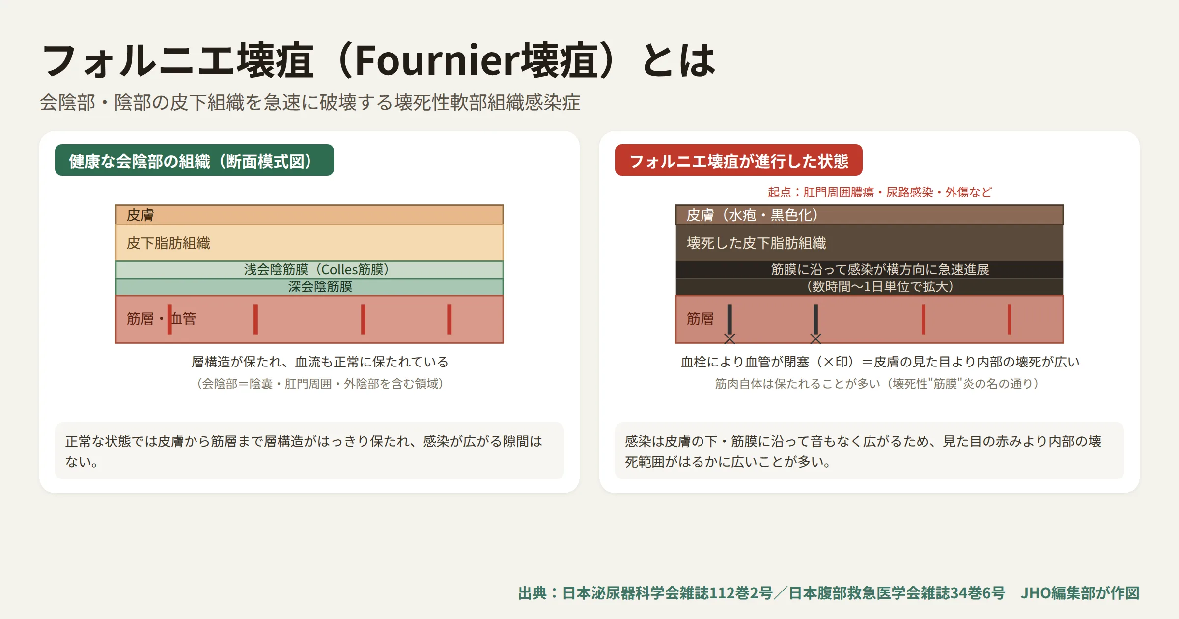 健康な会陰部の皮下組織の断面図と、フォルニエ壊疽が進行した状態の断面図を並べた模式図。健康な状態は皮膚・皮下脂肪・浅会陰筋膜・深会陰筋膜・筋層の層構造と血管が保たれているのに対し、フォルニエ壊疽が進行した状態は筋膜に沿って黒色壊死が横方向に急速に広がり、血栓により血管が閉塞している
