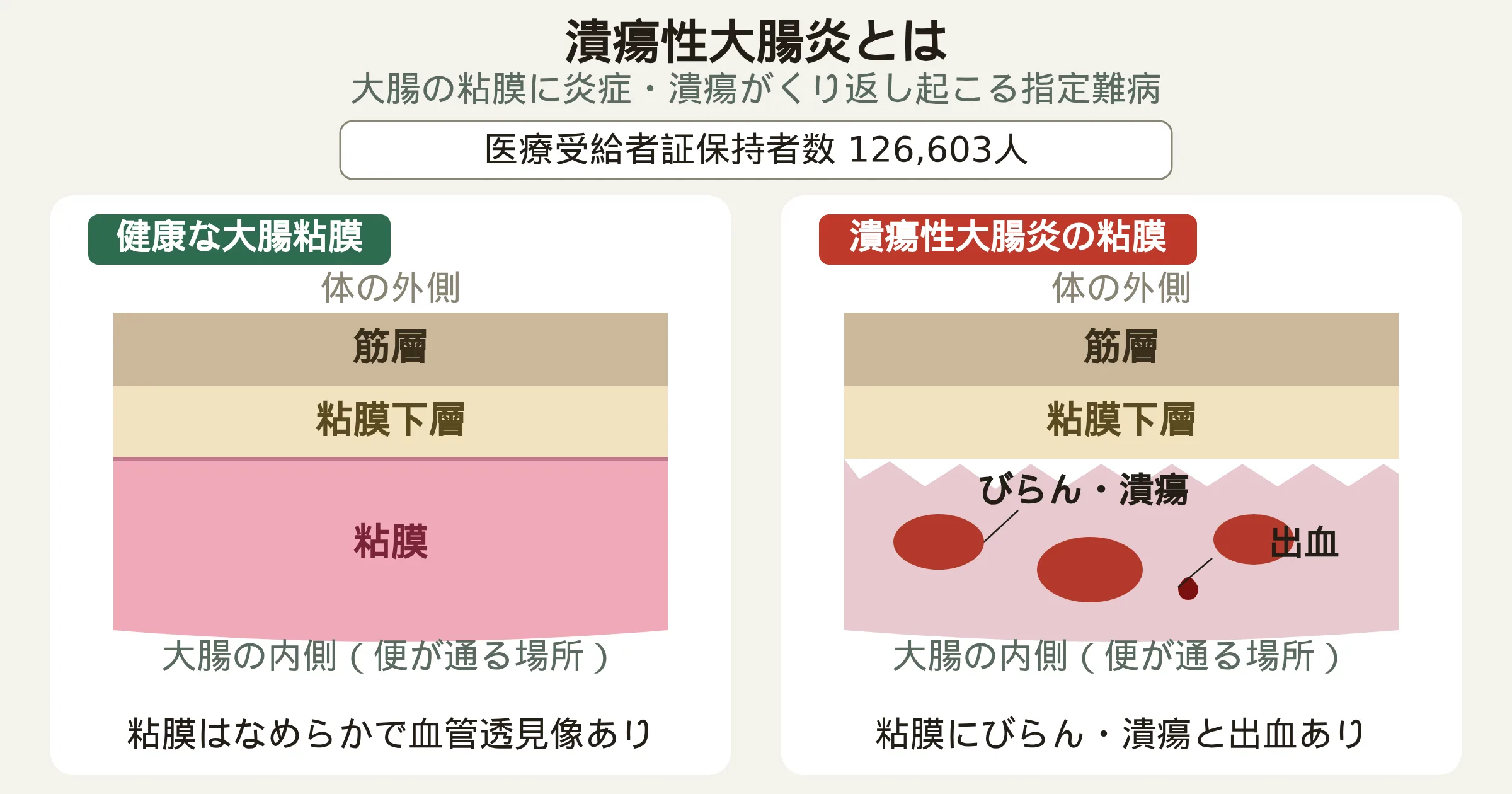 潰瘍性大腸炎の粘膜の断面図。健康な粘膜と、びらん・潰瘍・出血がみられる潰瘍性大腸炎の粘膜を比較