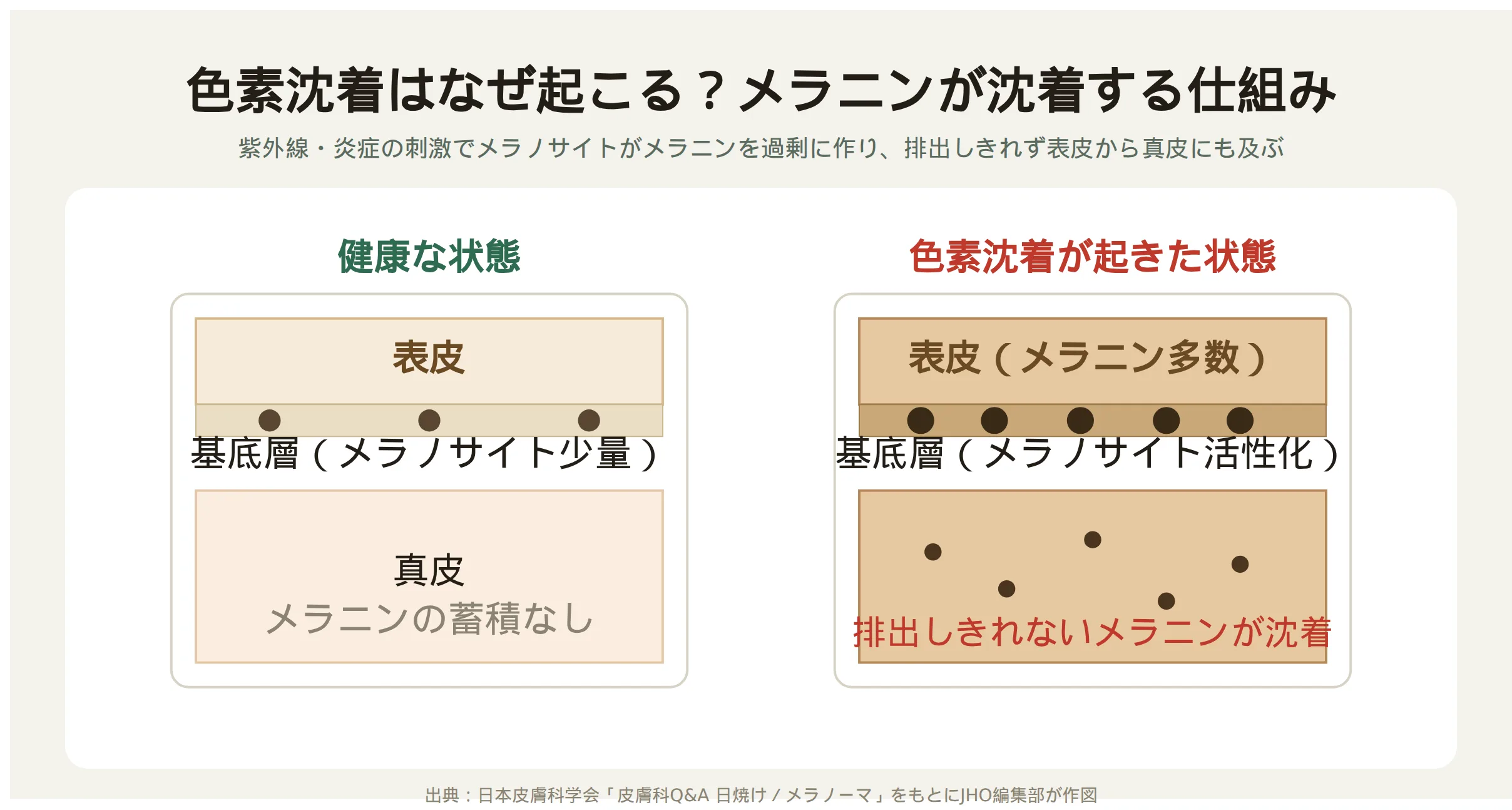 色素沈着の仕組み：健康な状態と色素沈着が起きた状態の断面比較図（表皮から真皮にかけてメラニンが沈着）