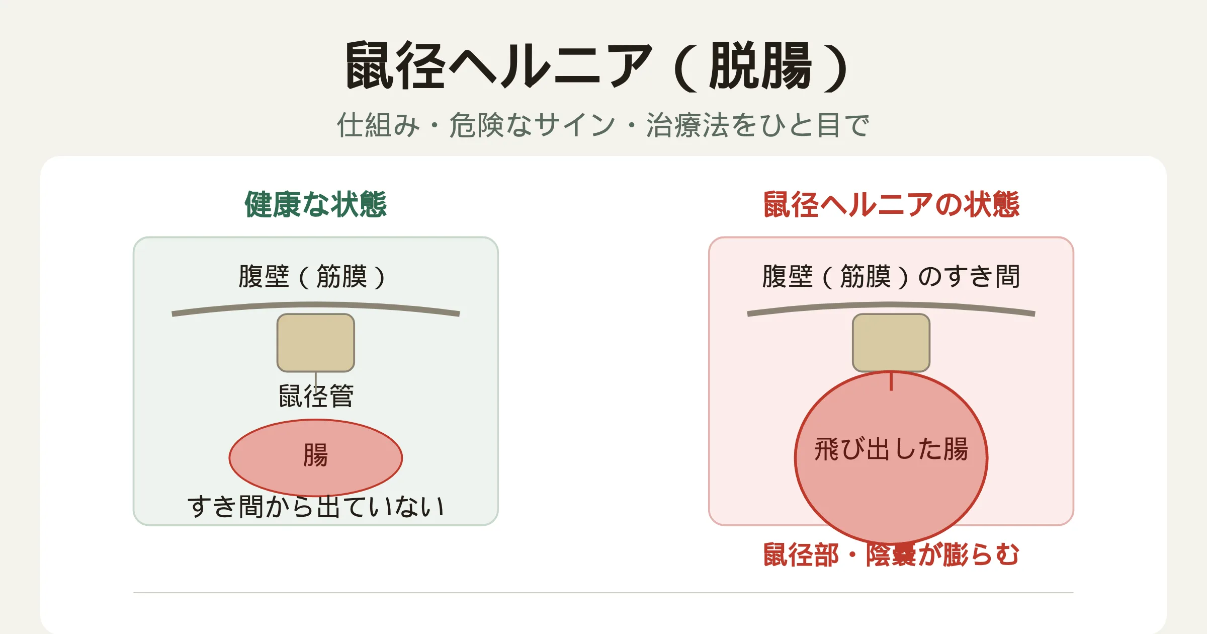鼠径ヘルニアの仕組みと危険なサインを示す図解。鼠径部の筋膜のすき間から腸の一部が飛び出す様子と、健康な状態との比較