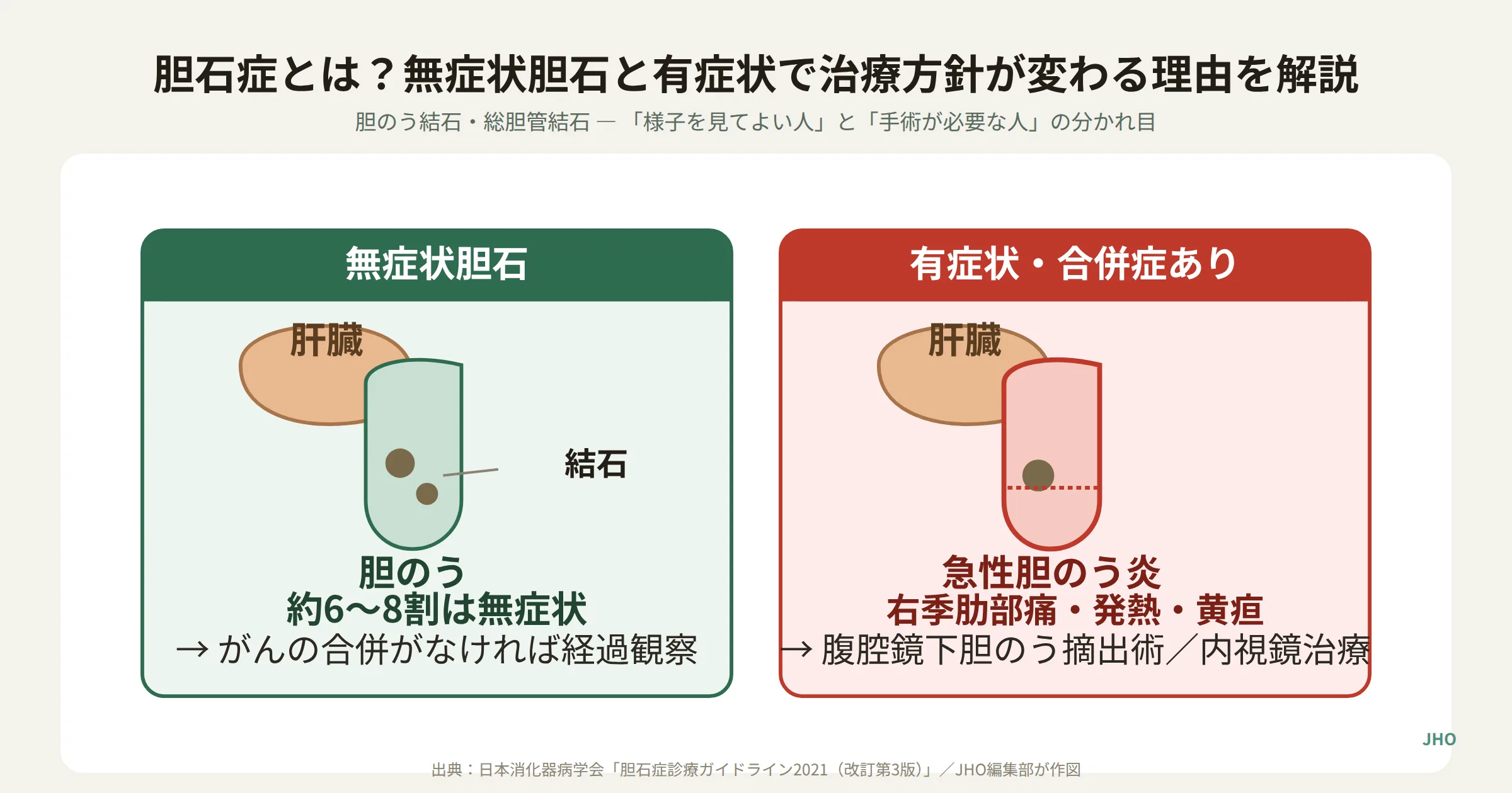 無症状胆石は経過観察、有症状の胆石発作や急性胆のう炎・急性胆管炎・急性膵炎を合併した場合は手術や内視鏡治療が必要になることを示す比較図