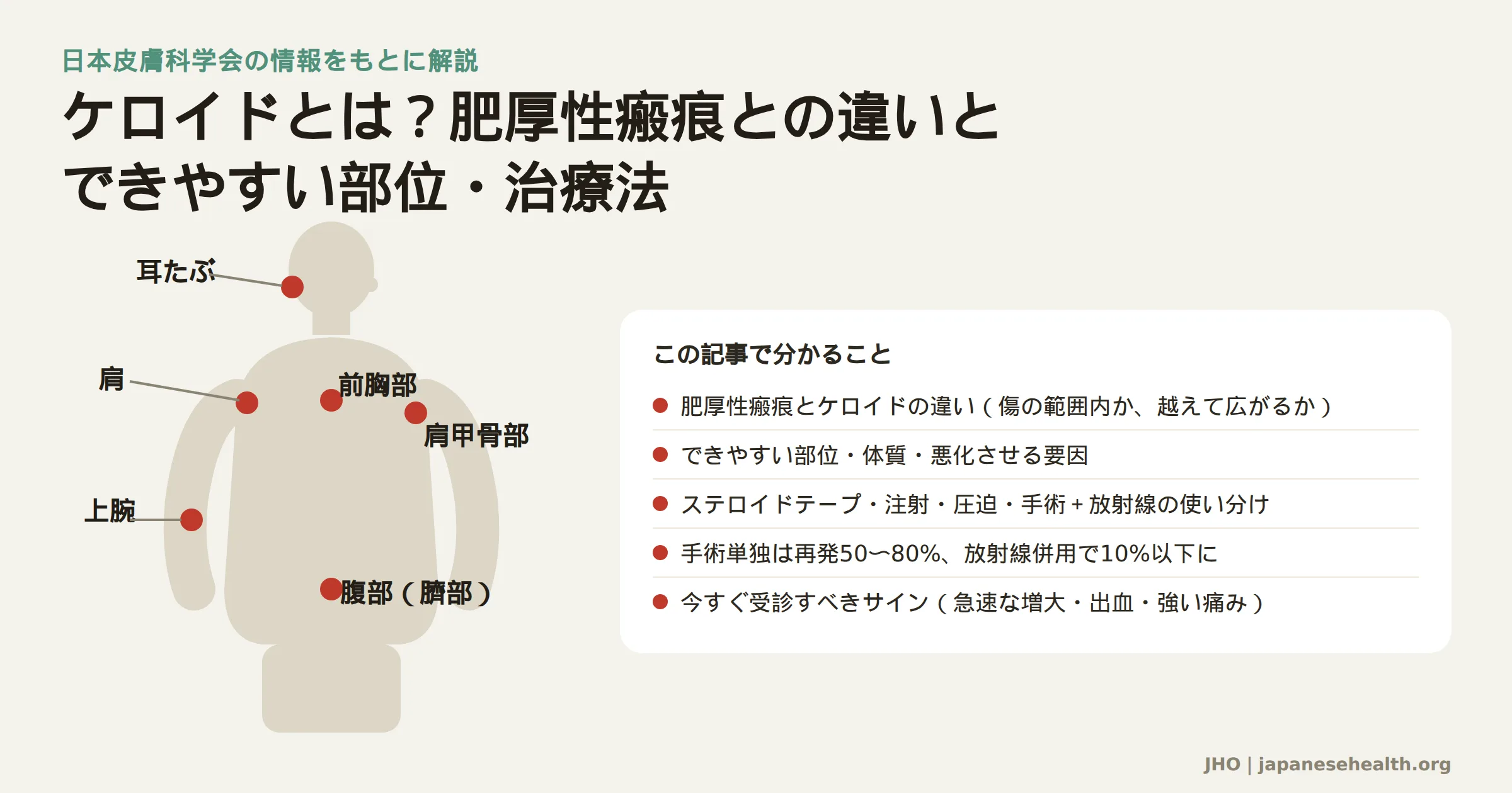 ケロイドができやすい部位（耳たぶ・前胸部・肩・肩甲骨部・上腕・腹部）を人体図に示した図と、記事で分かることのまとめ