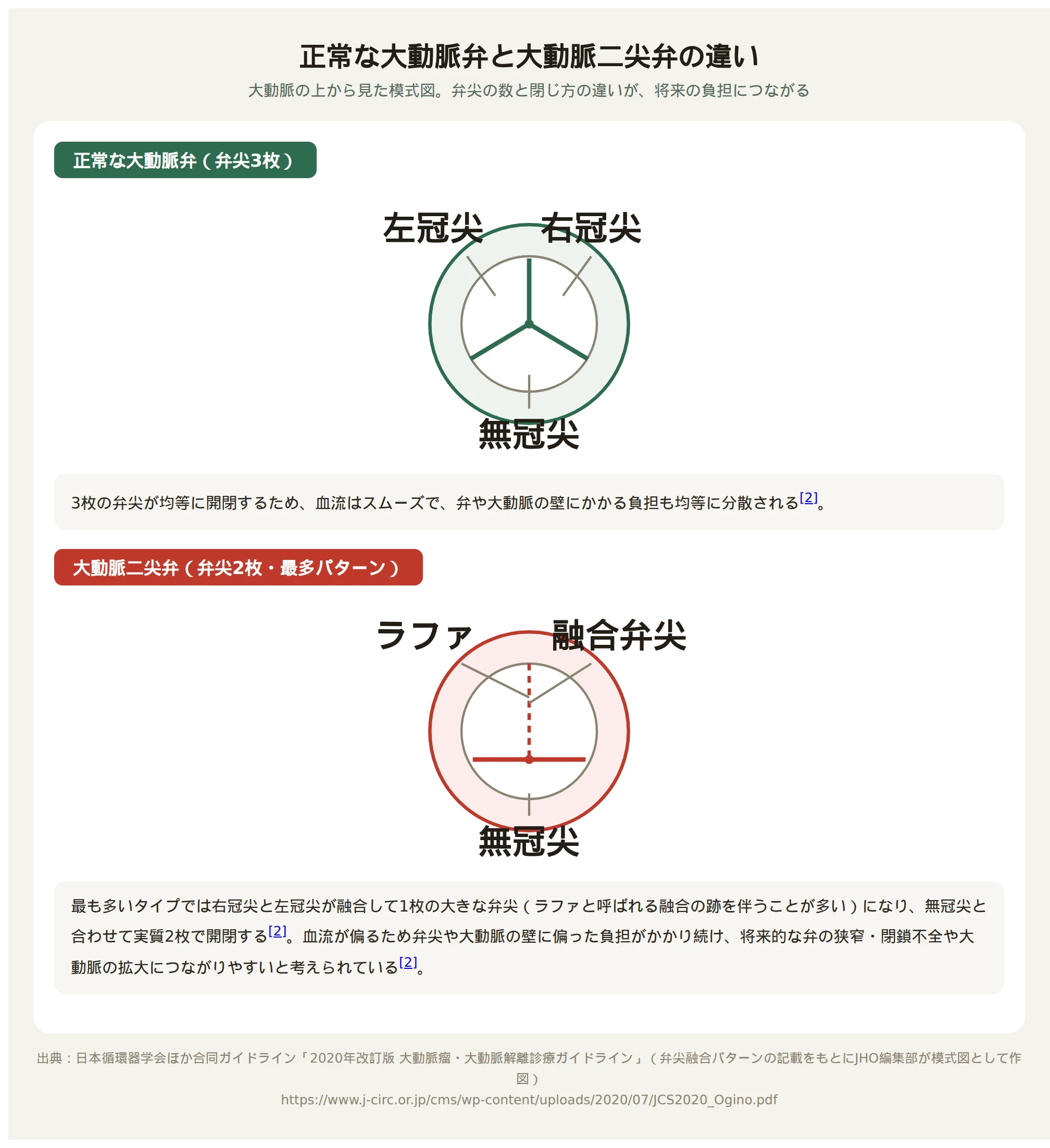 正常な大動脈弁(弁尖3枚)と大動脈二尖弁(弁尖2枚、右冠尖と左冠尖が融合した状態)を上から見た比較図