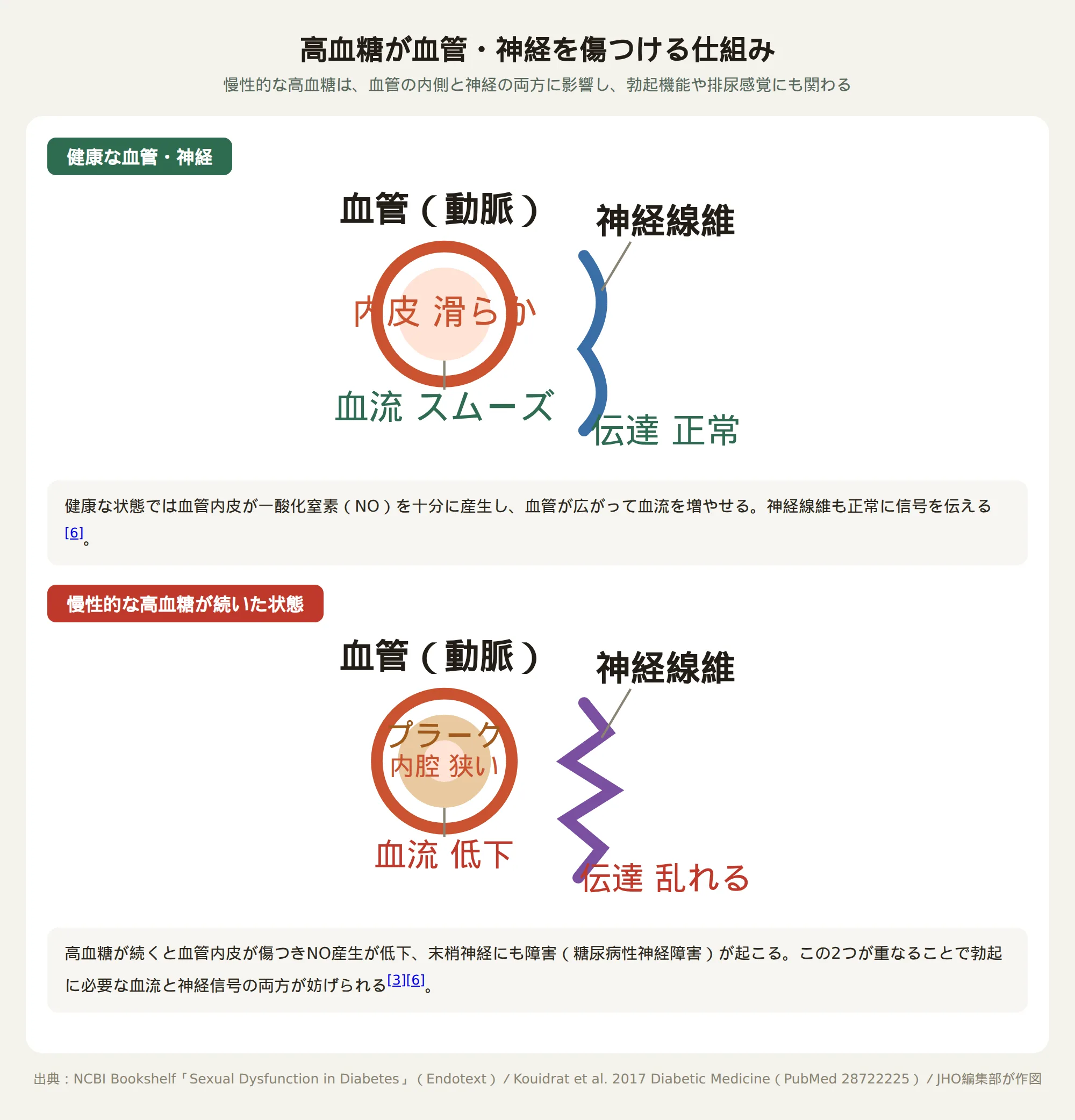 高血糖が血管と神経を傷つける仕組みを示す図。健康な血管は内皮が滑らかで血流がスムーズ、神経線維もまっすぐだが、慢性的な高血糖ではプラークで内腔が狭くなり血流が低下し、神経線維も損傷して信号が乱れる