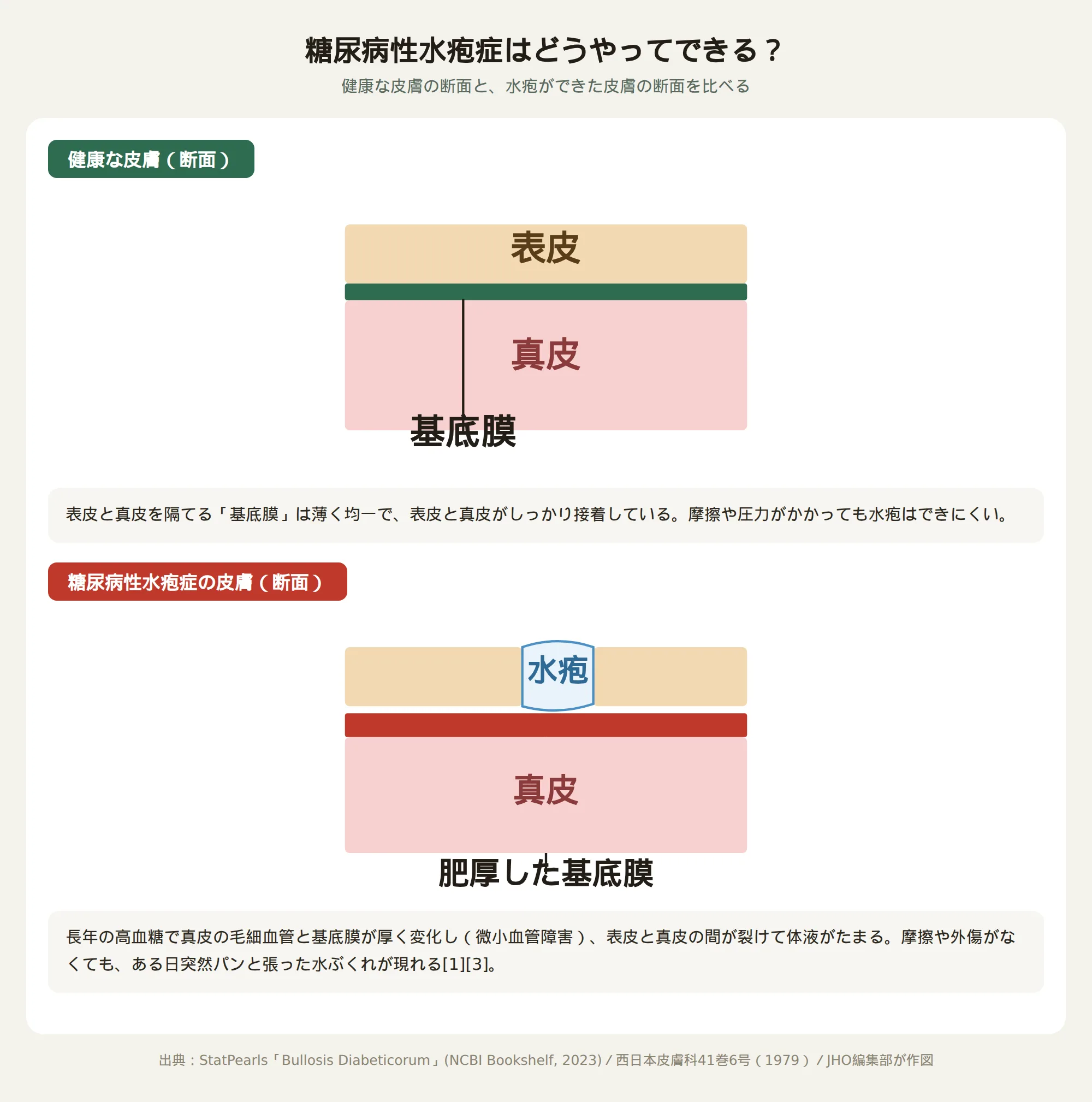 糖尿病性水疱症の仕組みを示す健康な皮膚と水疱ができた皮膚の断面模式図