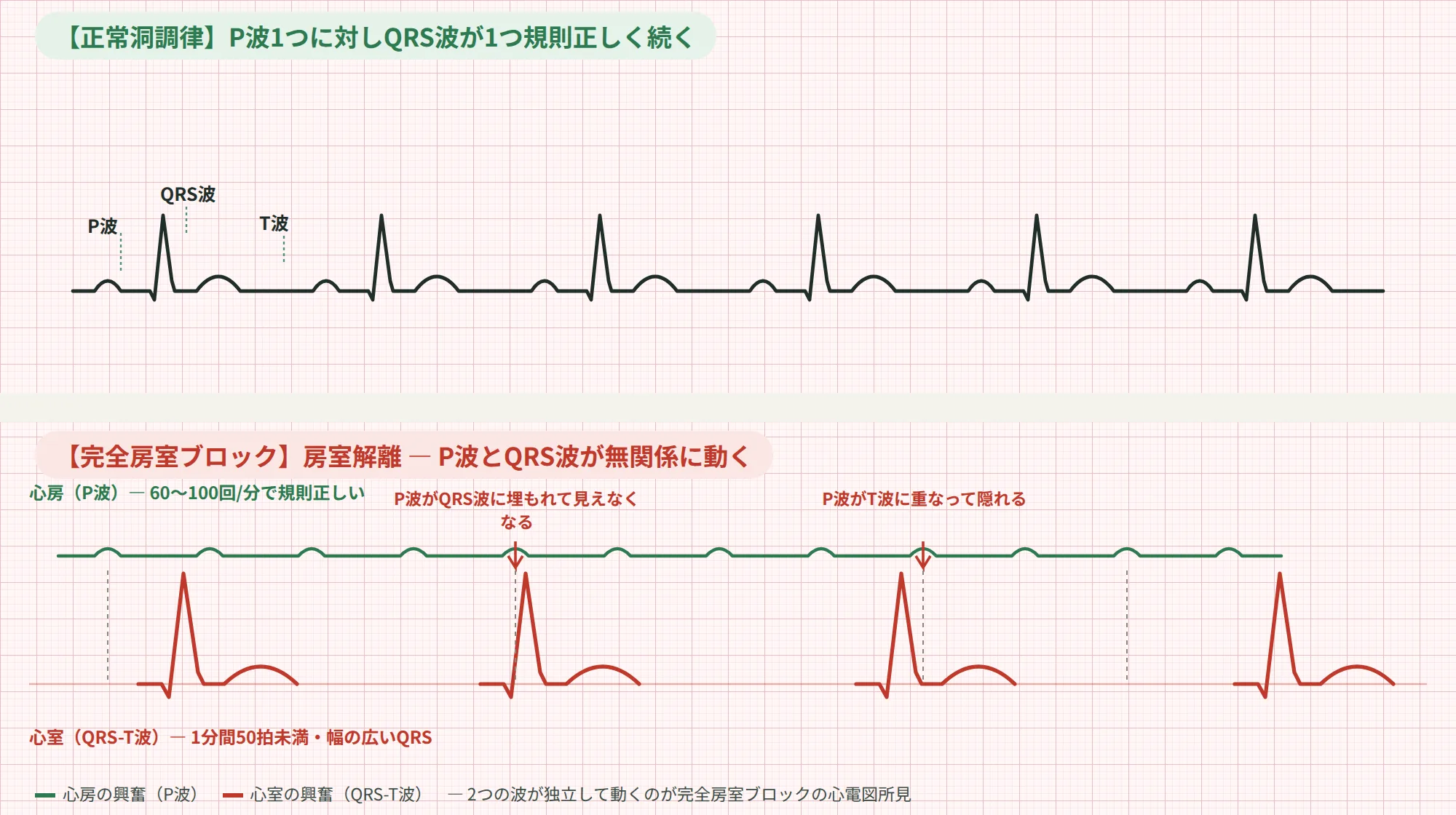 正常洞調律と完全房室ブロック（房室解離）の心電図波形の比較図。正常ではP波とQRS波が1対1で続くが、完全房室ブロックではP波とQRS波が無関係に動き、P波がQRS波やT波に埋もれる様子を示す