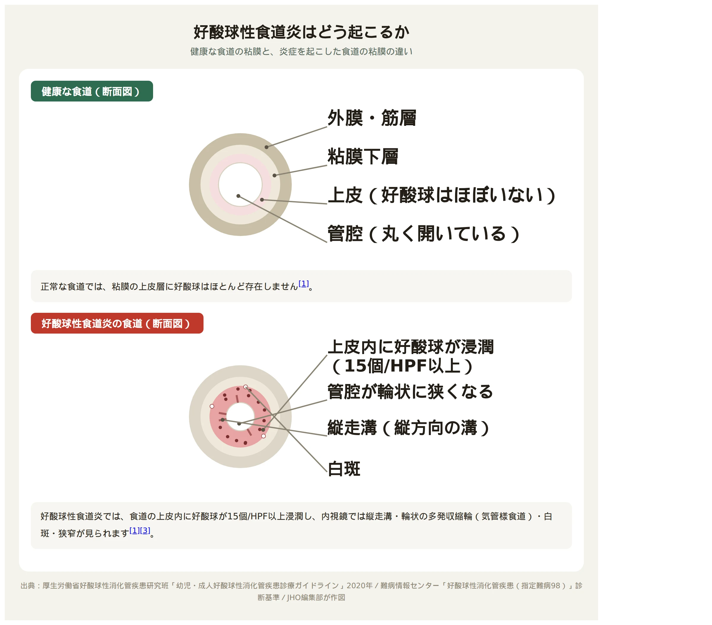 好酸球性食道炎の食道断面図。健康な食道と、上皮内に好酸球が浸潤し輪状の狭窄・縦走溝・白斑が見られる食道を対比した図