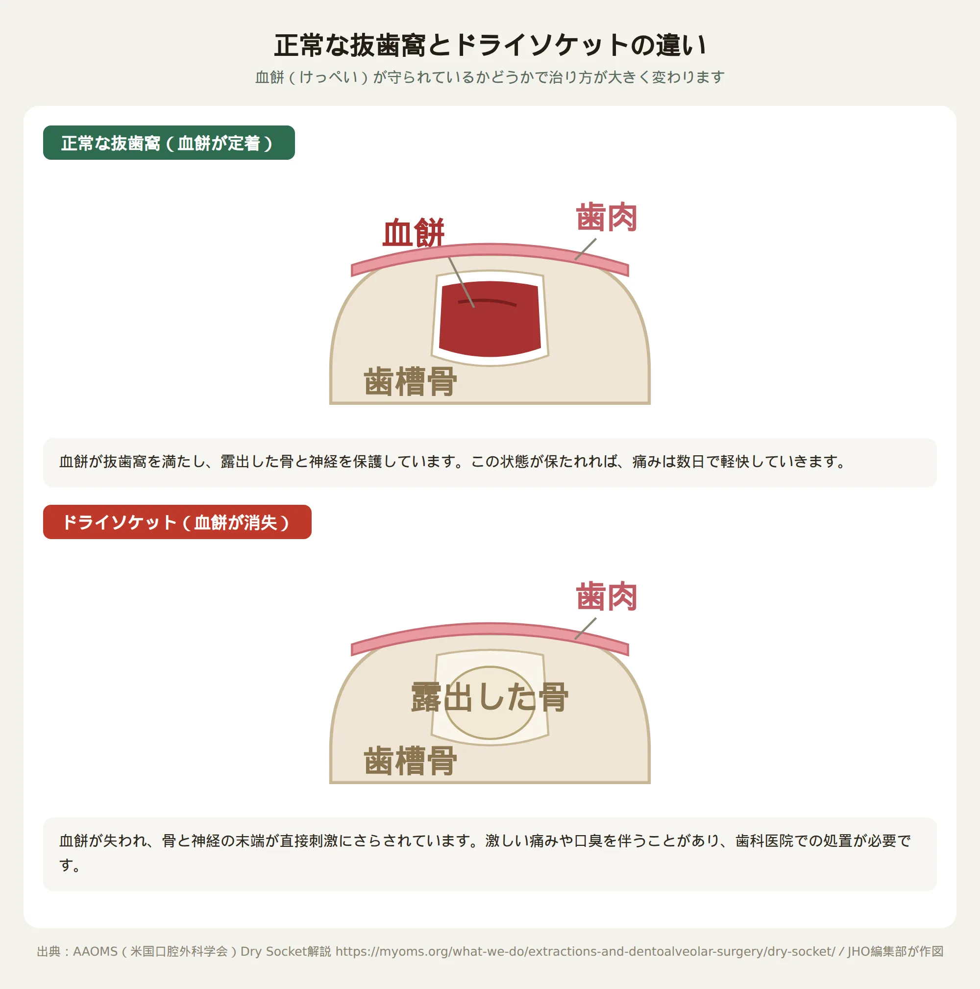 正常な抜歯窩とドライソケットの違いを示す断面図