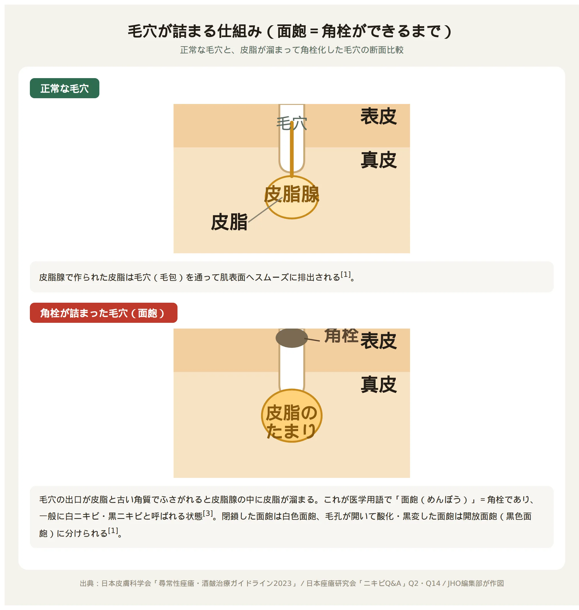 正常な毛穴と角栓が詰まった毛穴（面皰）の断面比較図