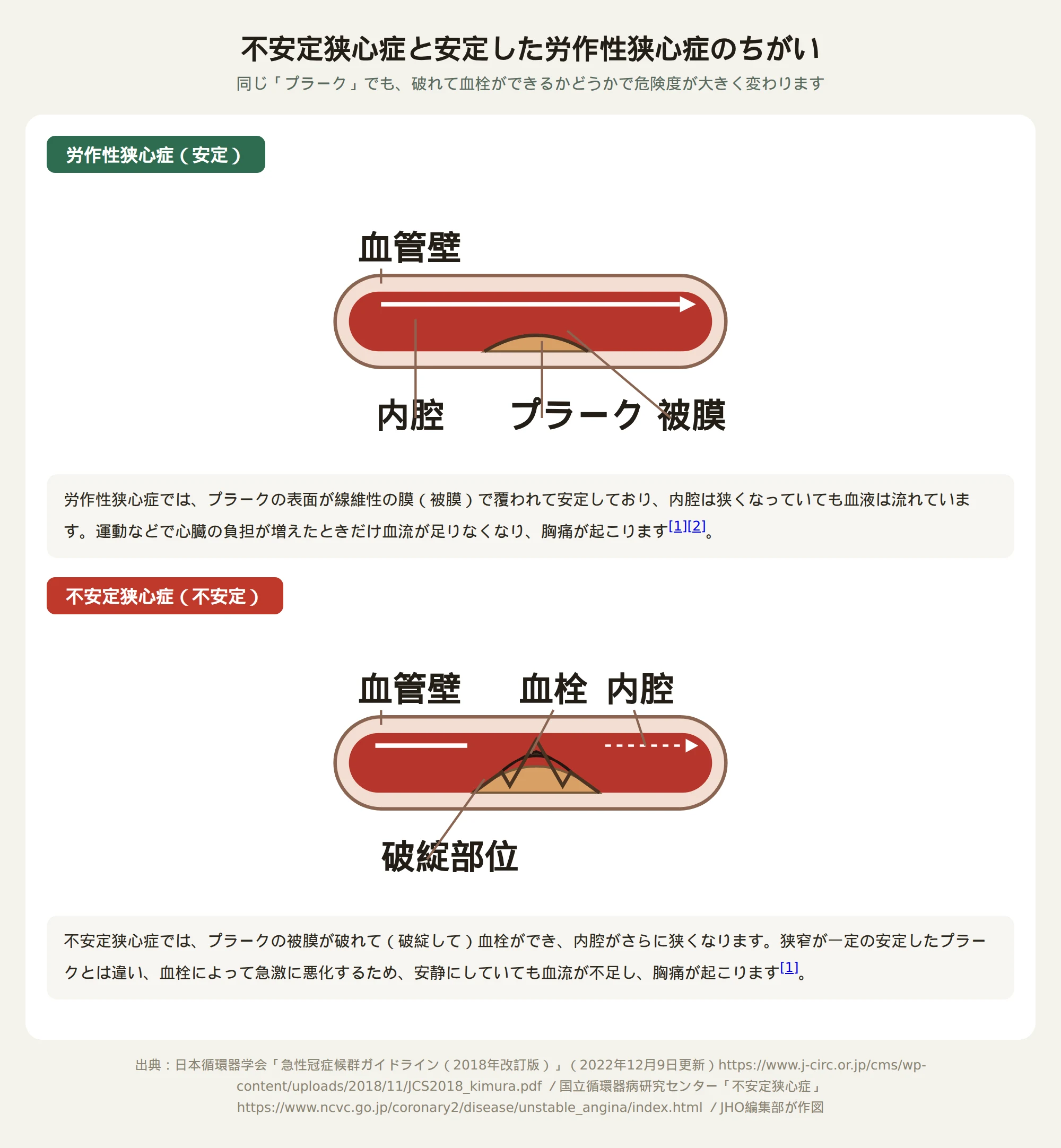 冠動脈プラークの破綻と血栓形成による不安定狭心症の発症機序と安定狭心症との違いを示した図