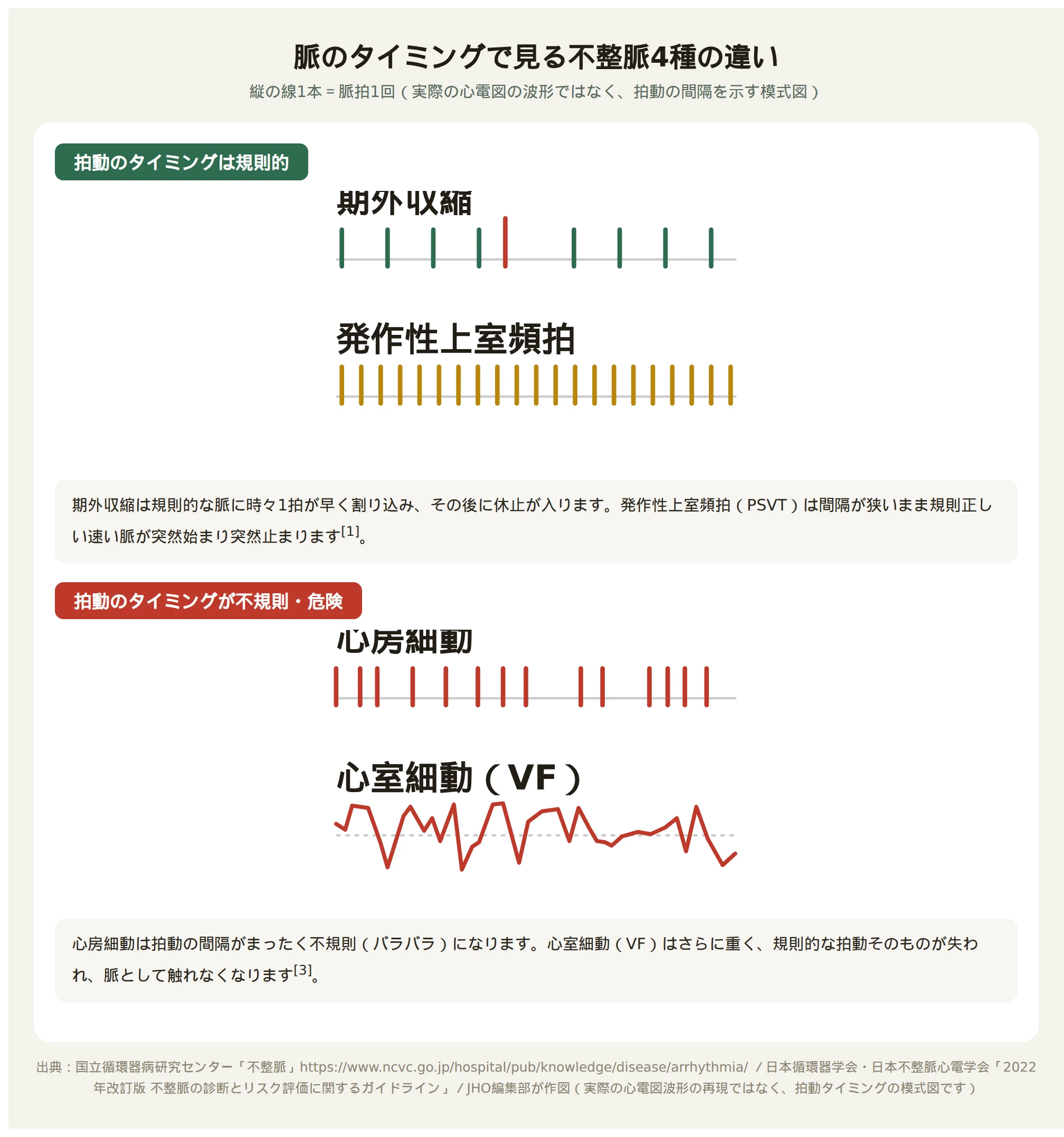 期外収縮・心房細動・発作性上室頻拍・心室細動の脈の波形を比較した図