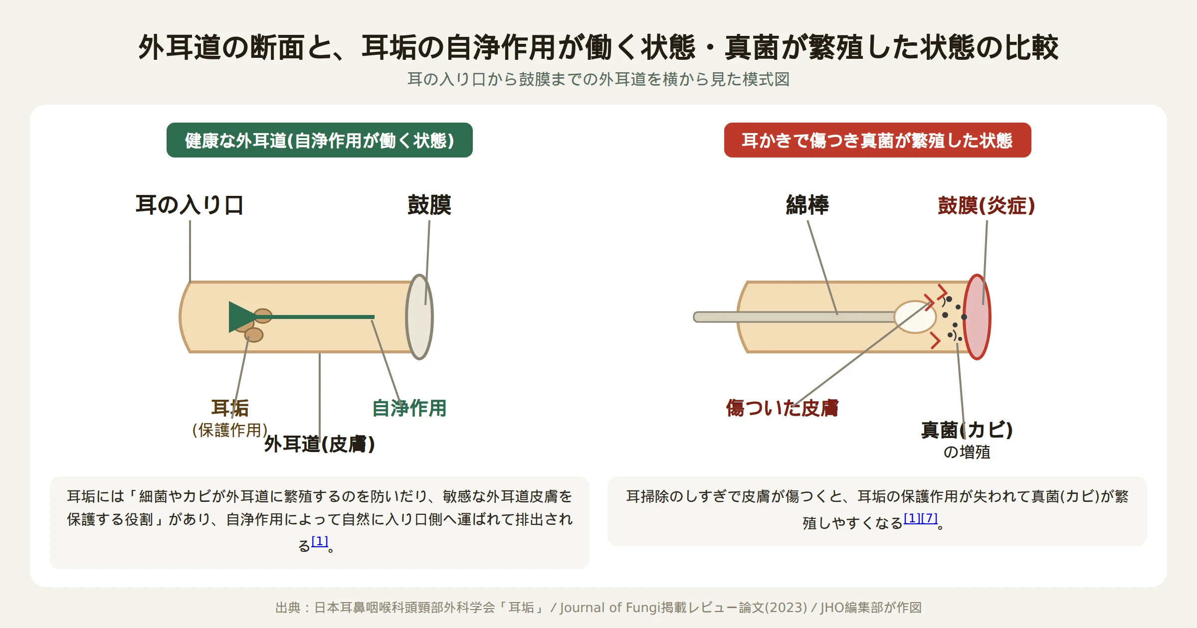 外耳道の構造と、耳垢の自浄作用が働く正常な状態と耳かきで傷つき真菌が繁殖した状態を比較した図