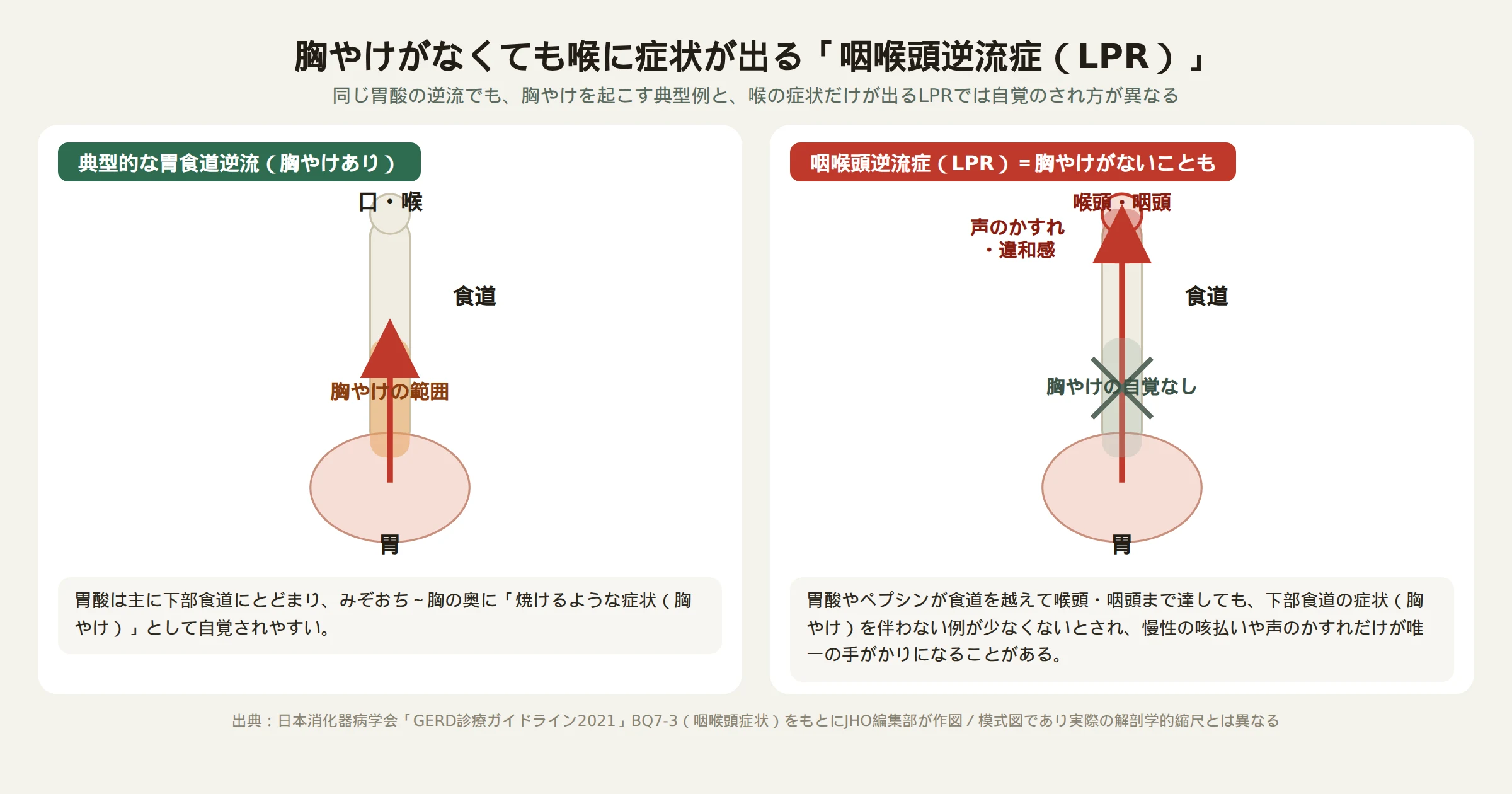 胸やけを伴わない咽喉頭逆流症（LPR）と、胸やけを伴う典型的な胃食道逆流の違いを示す図