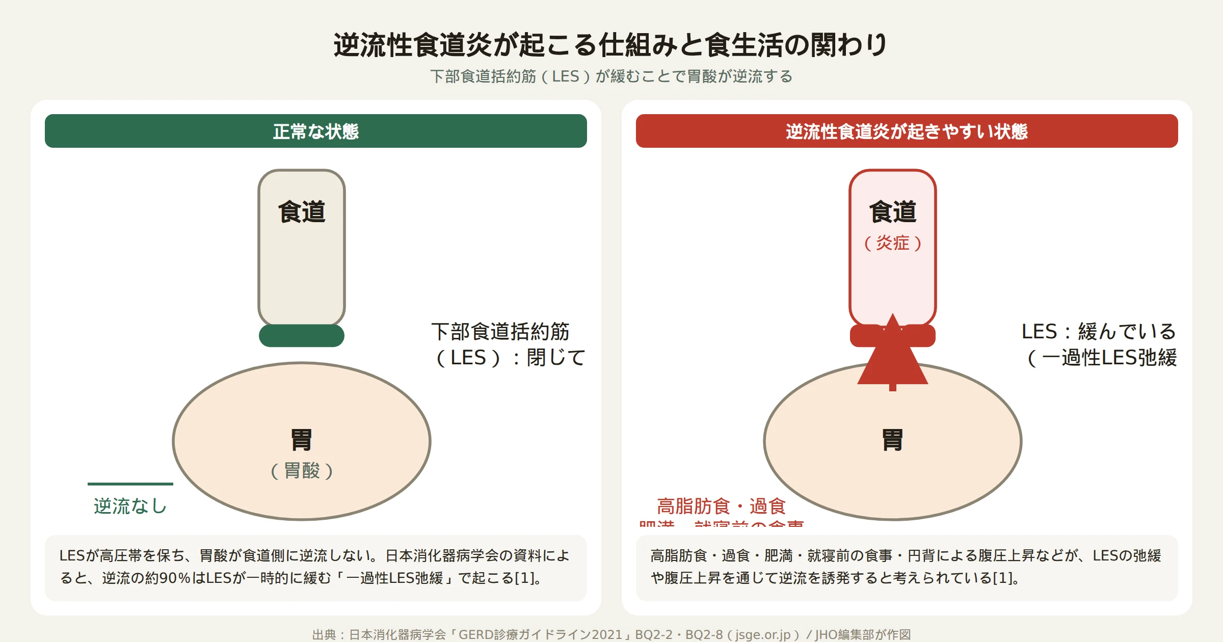 逆流性食道炎で下部食道括約筋が緩み胃酸が逆流する仕組みの図
