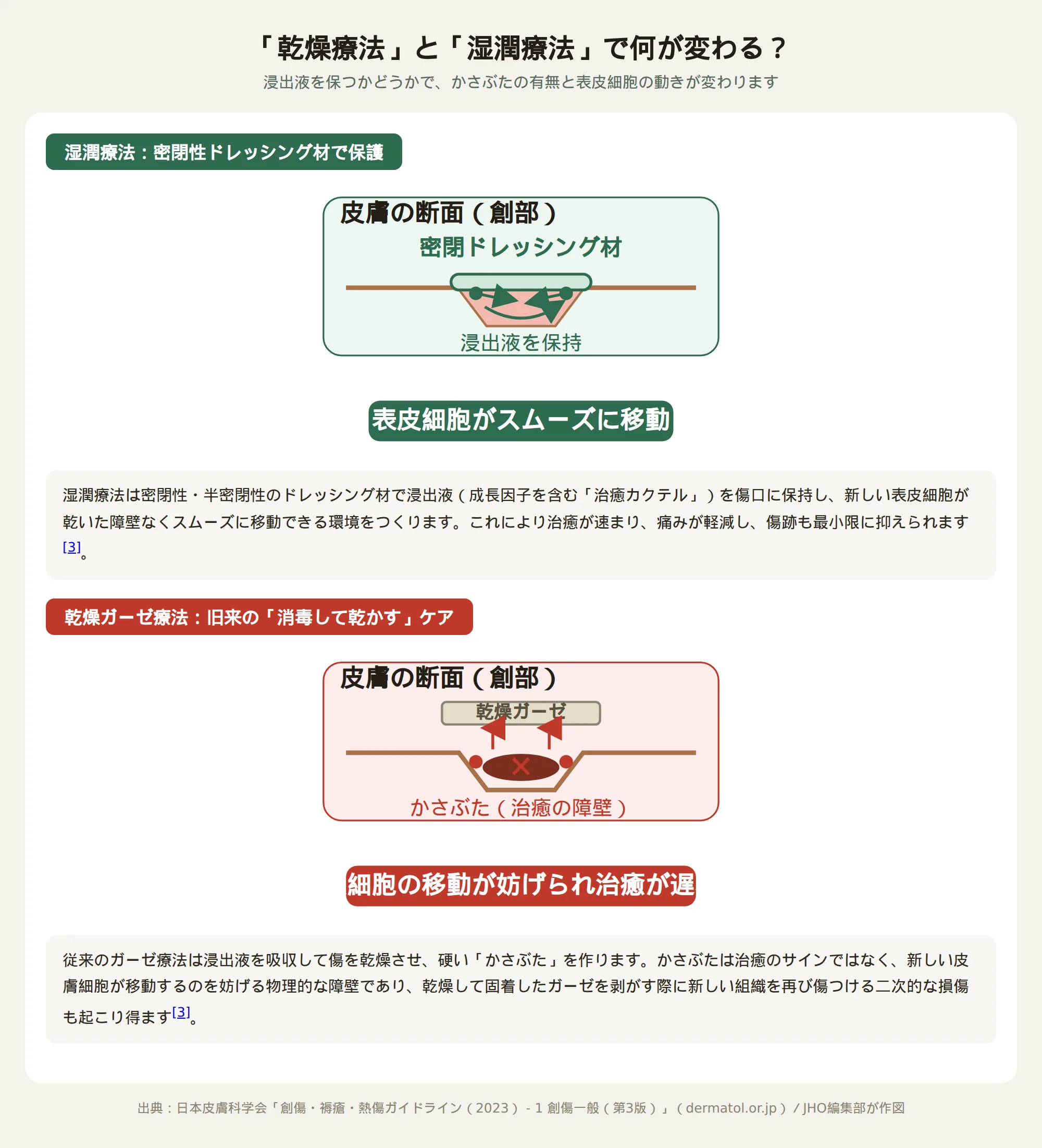 「乾燥療法」と「湿潤療法」の傷の治り方の違いを示す図解:密閉ドレッシング材で浸出液を保持すると表皮細胞がスムーズに移動し、乾燥ガーゼではかさぶたが治癒の障壁になる