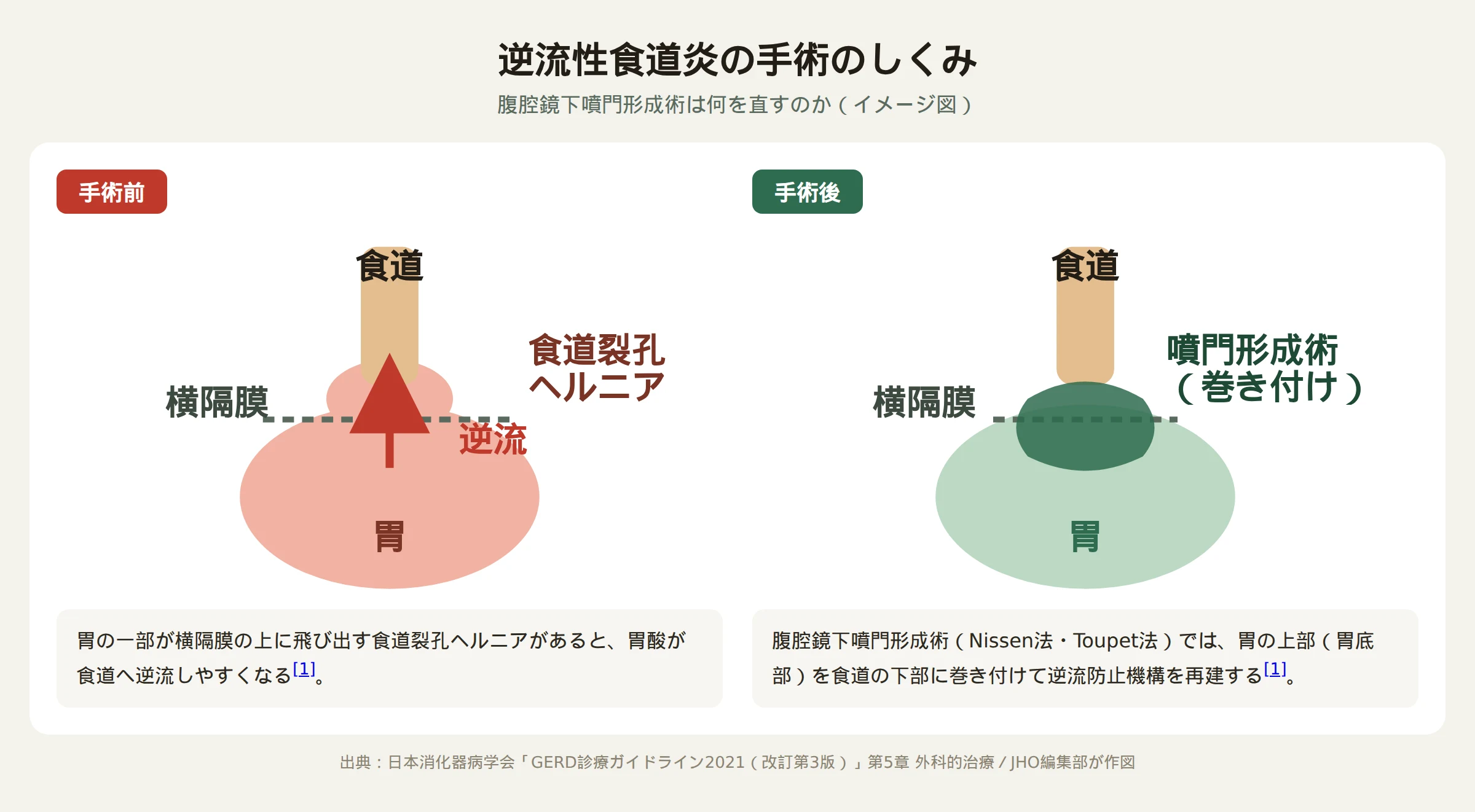 腹腔鏡下噴門形成術の手術前後で胃酸の逆流がどう変わるかを示す図