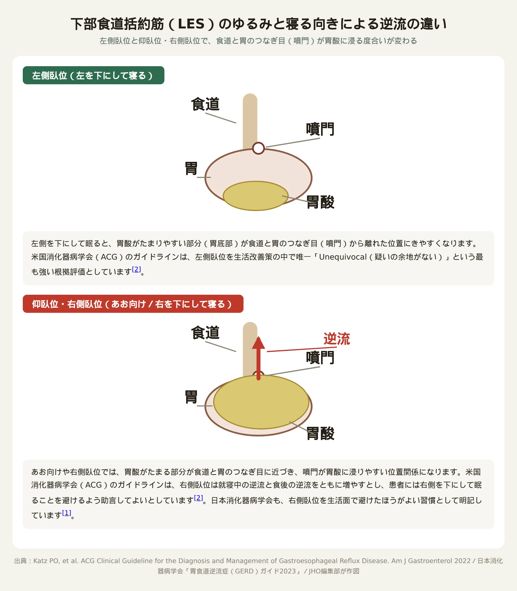 下部食道括約筋のゆるみによる胃酸逆流の仕組みと寝る向きによる違いを示した図